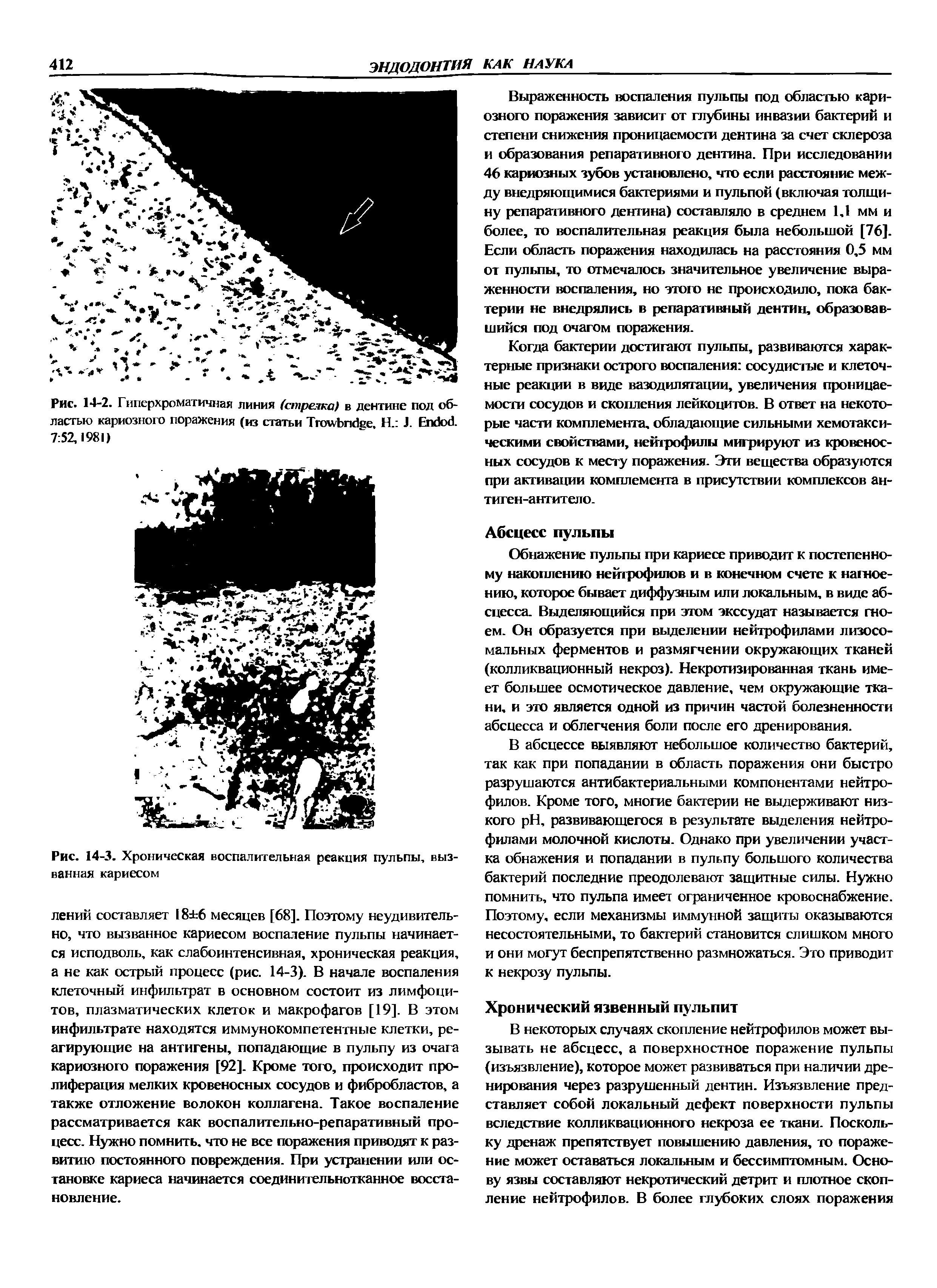 Рис. 14-3. Хроническая воспалительная реакция пульпы, вызванная кариесом...