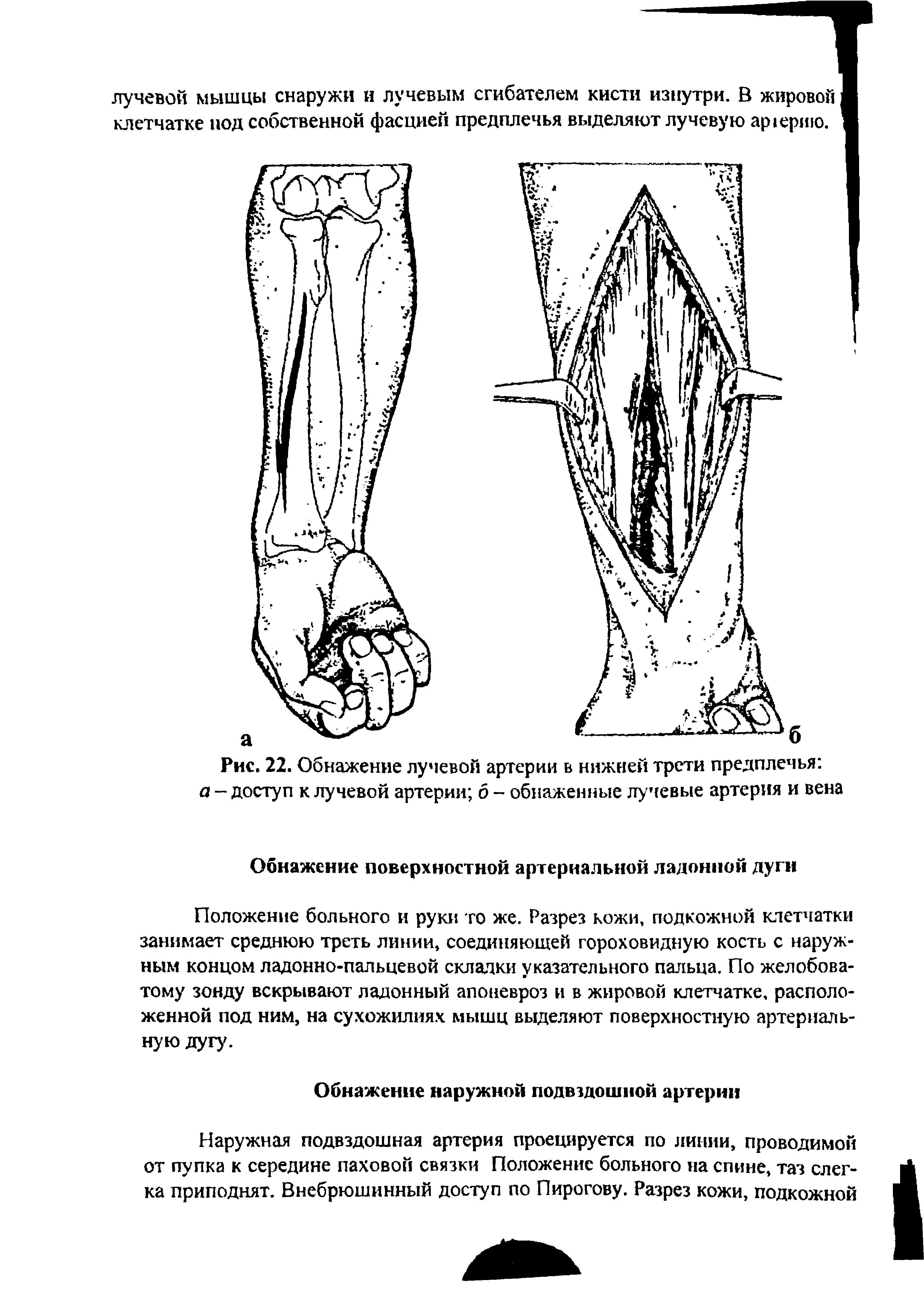 Рис. 22. Обнажение лучевой артерии в нижней трети предплечья а - доступ к лучевой артерии б - обнаженные лучевые артерия и вена...