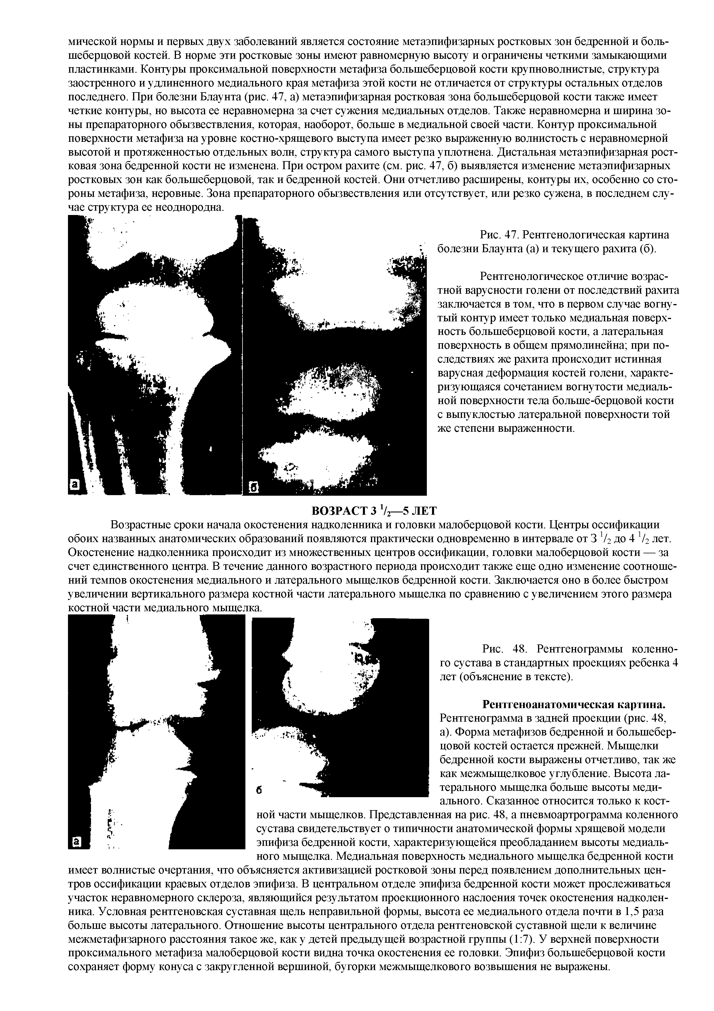 Рис. 47. Рентгенологическая картина болезни Блаунта (а) и текущего рахита (б).