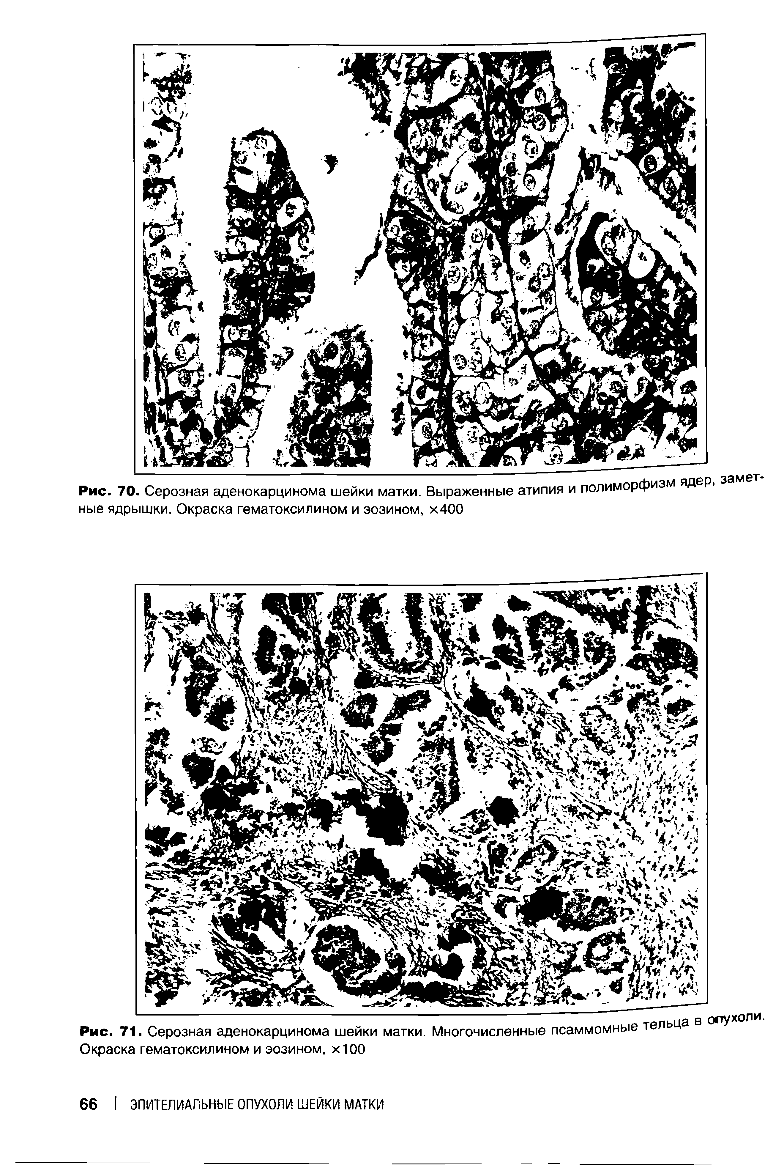 Рис. 71. Серозная аденокарцинома шейки матки. Многочисленные псаммомные Окраска гематоксилином и эозином, х100...