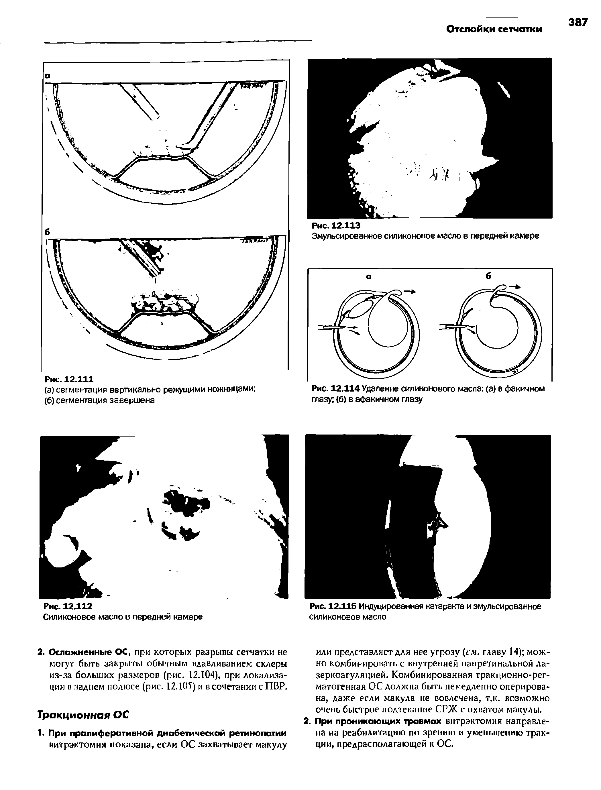 Рис. 12.114 Удаление силиконового масла (а) в факичном глазу (б) в афакичном глазу...