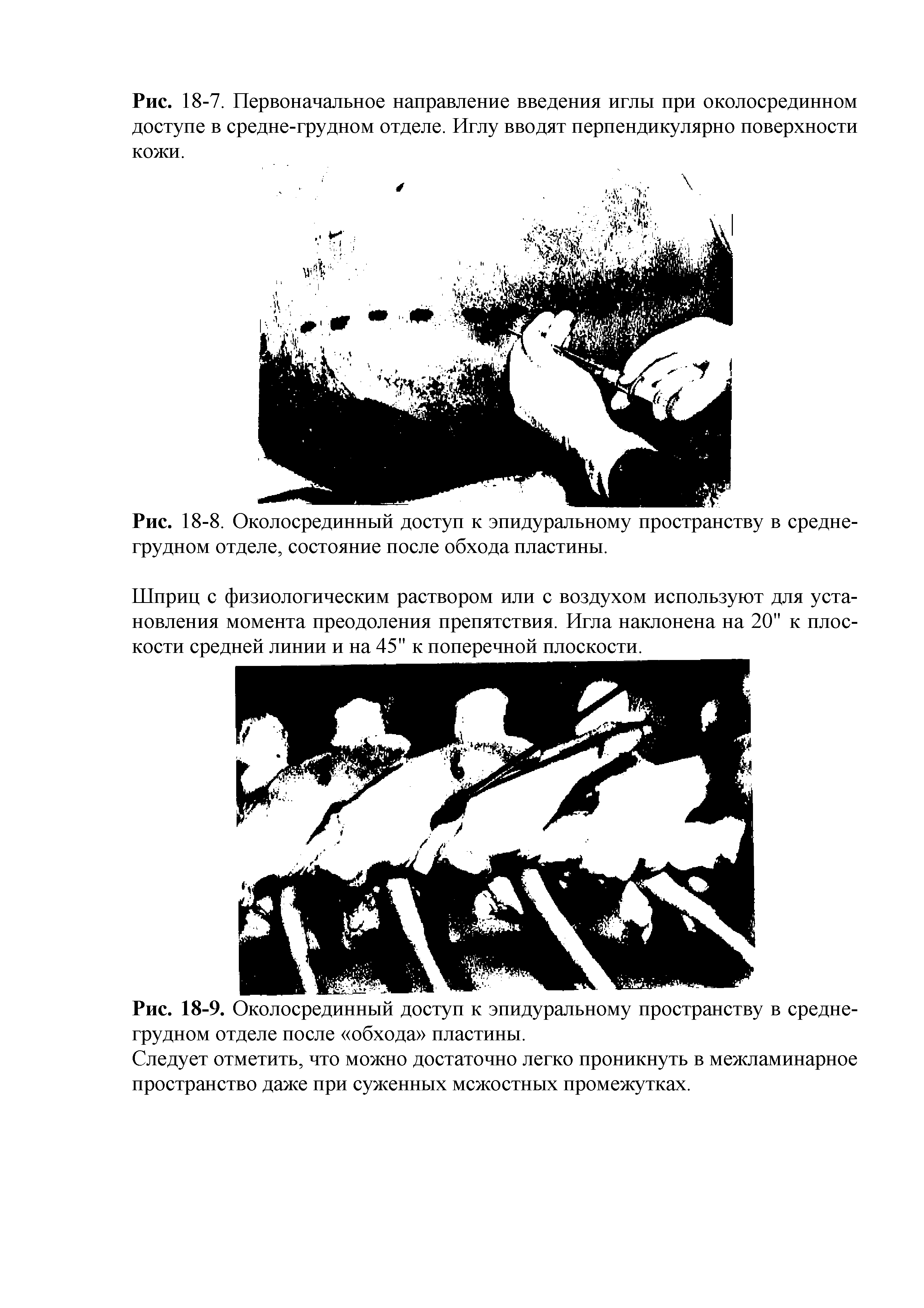 Рис. 18-8. Околосрединный доступ к эпидуральному пространству в среднегрудном отделе, состояние после обхода пластины.