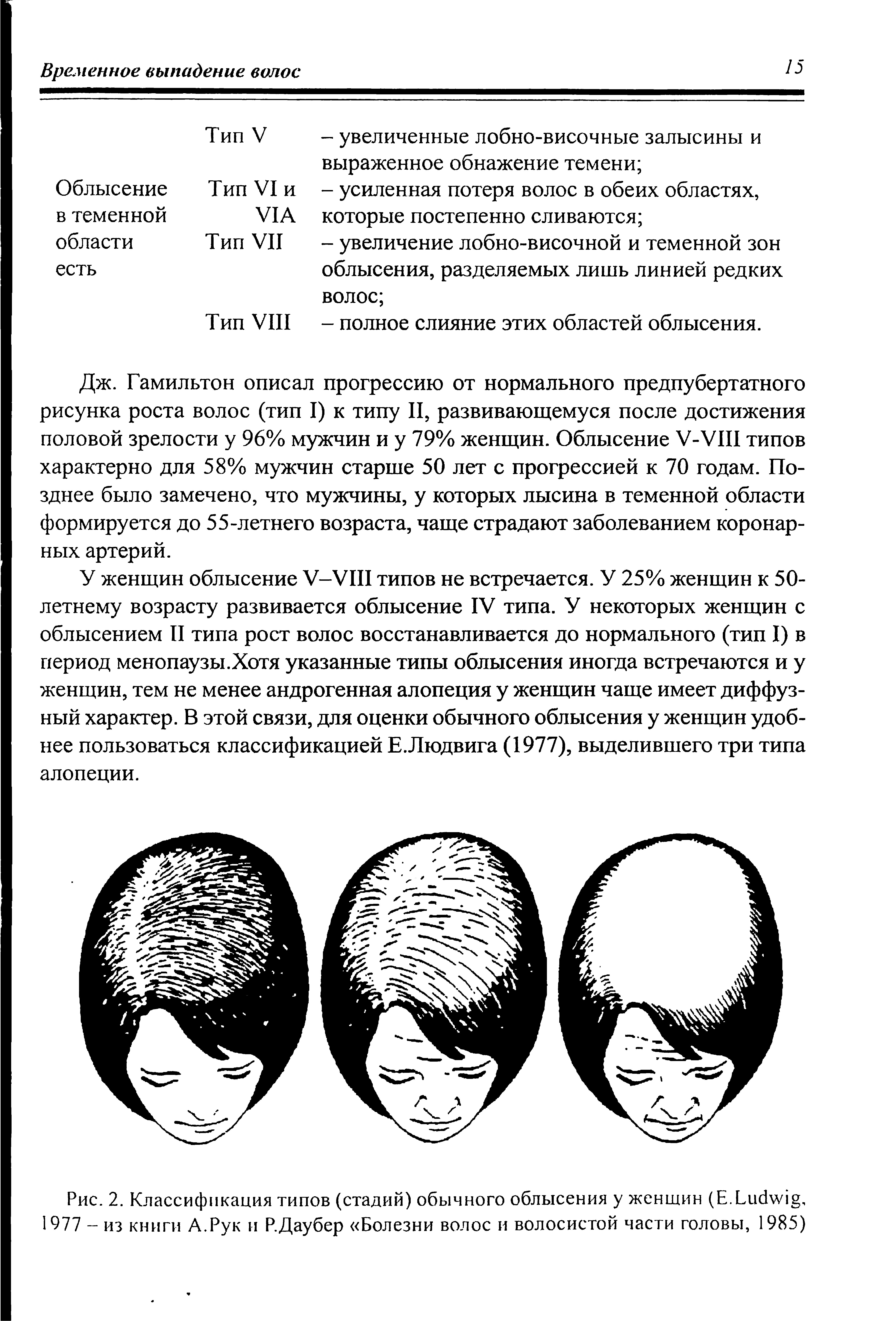 Рис. 2. Классификация типов (стадий) обычного облысения у женщин (Е.L , 1977 - из книги А.Рук и Р.Даубер Болезни волос и волосистой части головы, 1985)...