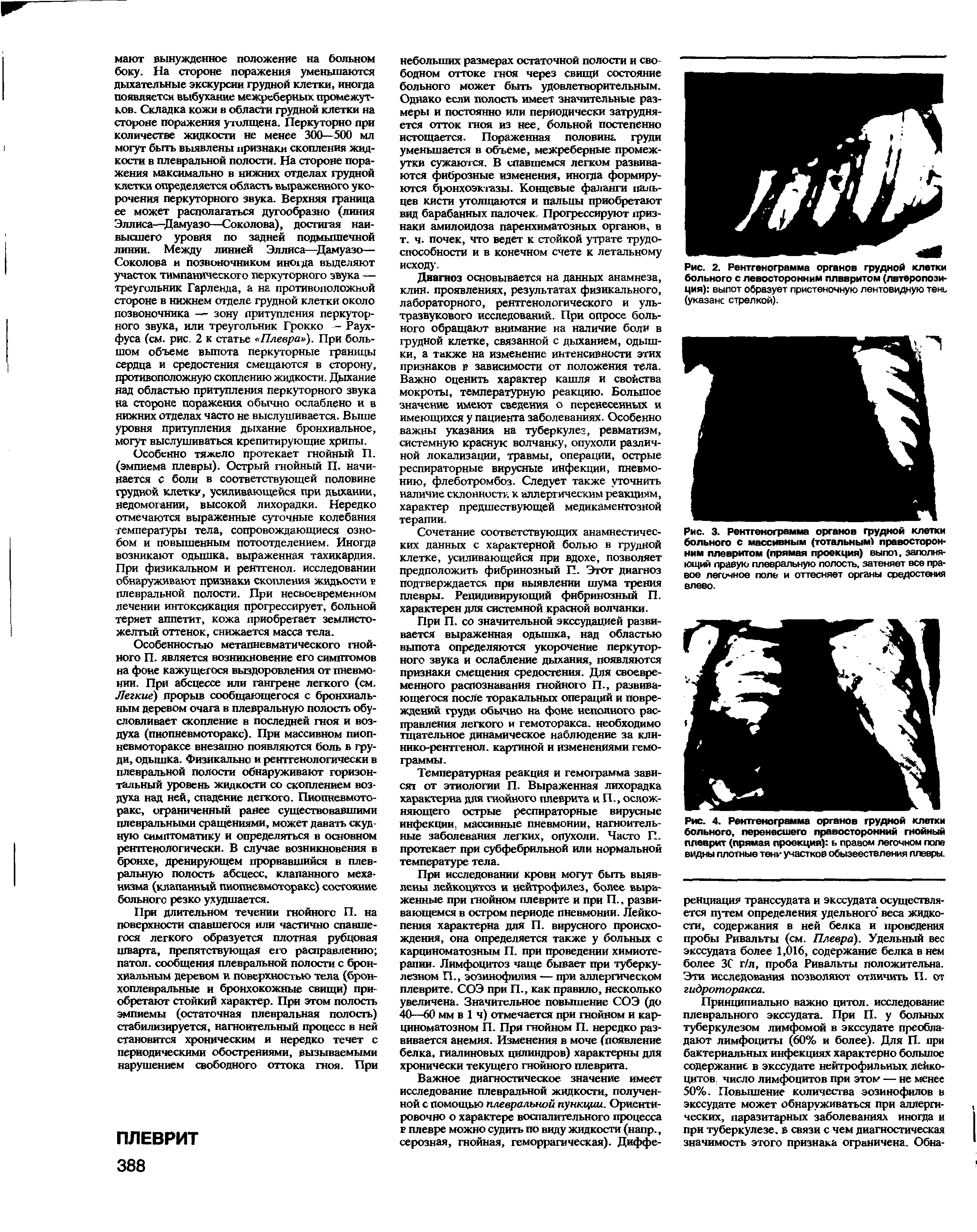 Рис. 4. Рентгенограмма органов грудной клетки больного, перенесшего правосторонний гнойный плеврит (прямая проекция) ь правом легочном попе видны плотные тени участков обызвествления плевры.