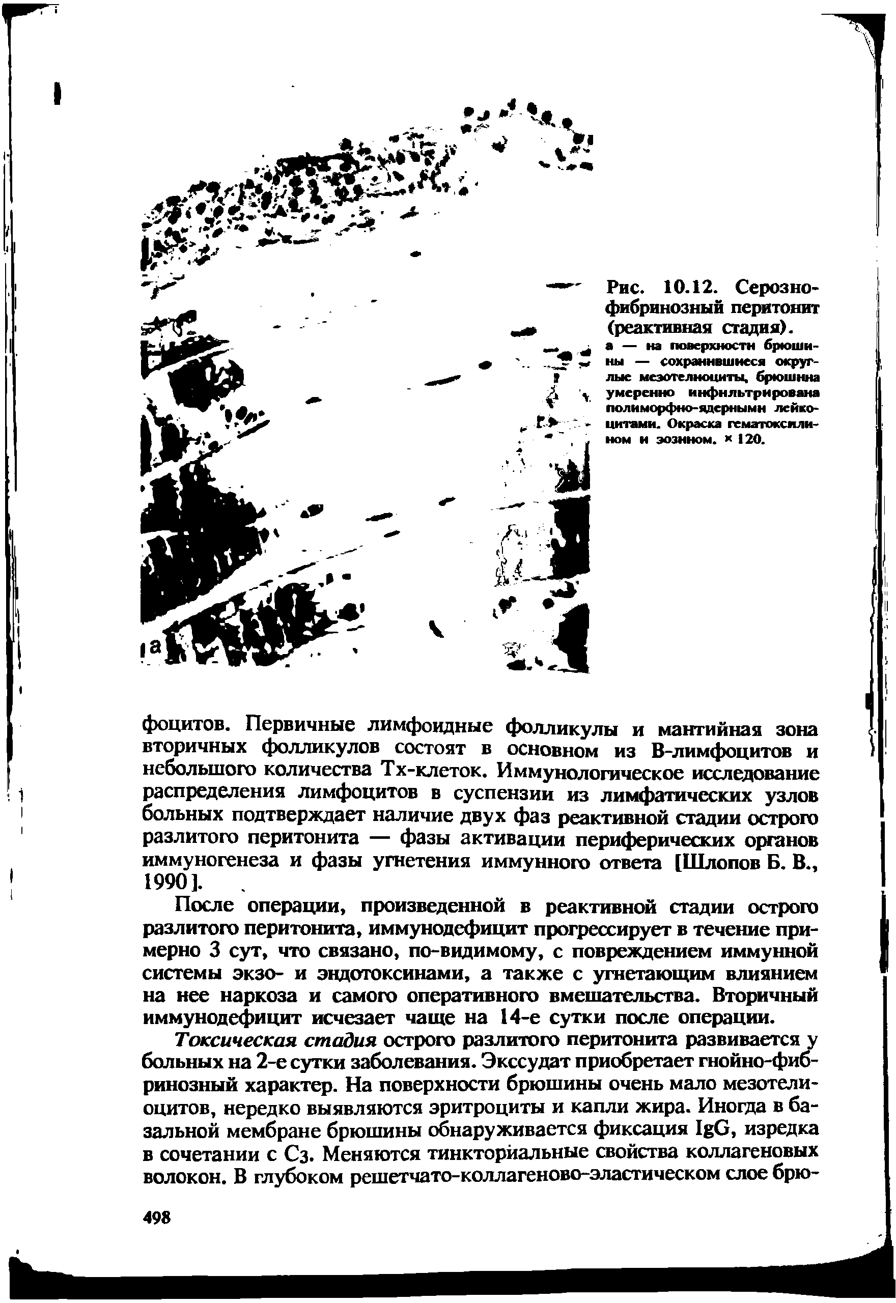 Рис. 10.12. Серозно-фибринозный перитонит (реактивная стадия), а — на поверхности брюшины — сохранившиеся округлые меэотелноциты, брюшина умеренно инфильтрирована полиморфно-адсрнымн лейкоцитами. Окраска гематоксилином и эозином, к 20.