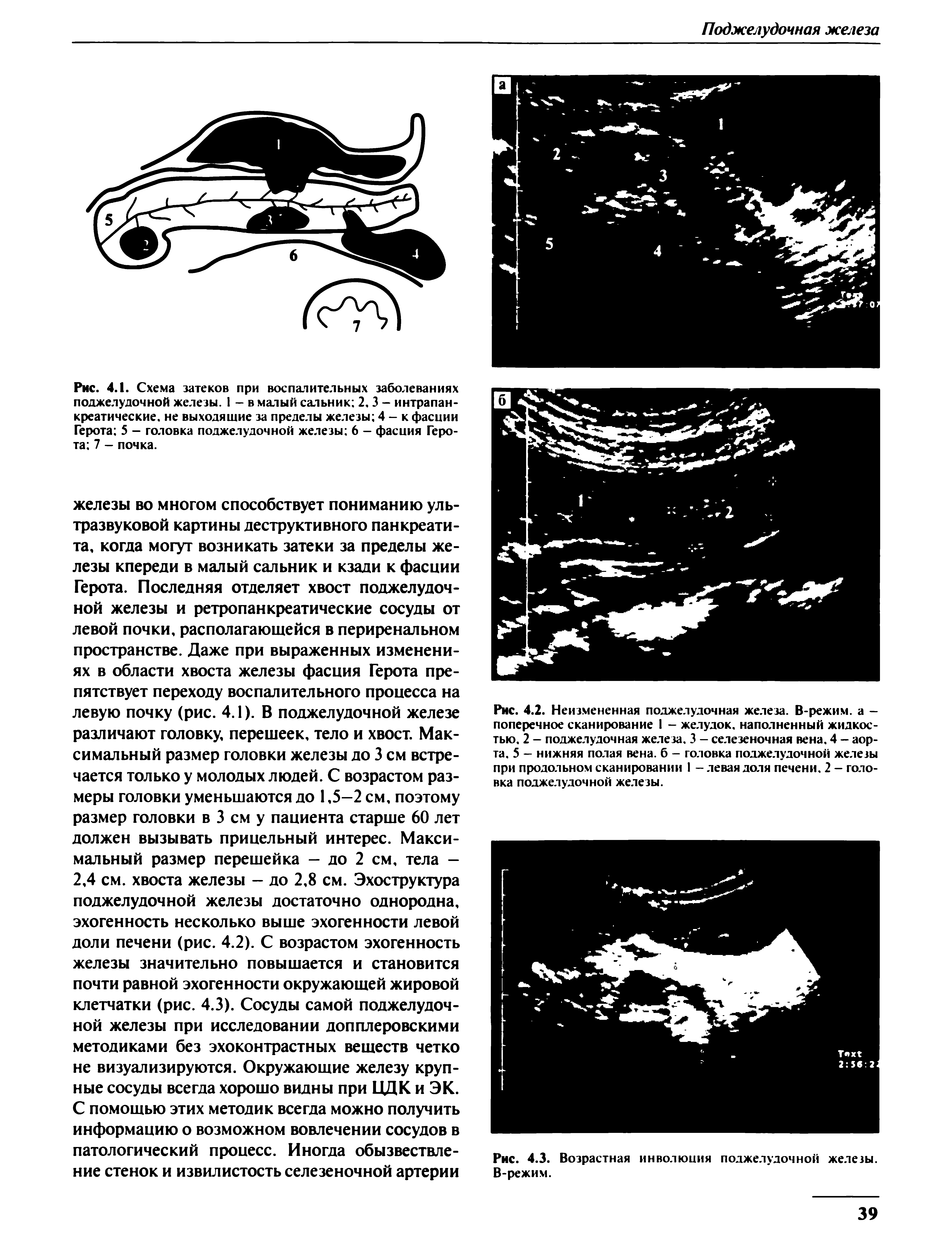 Рис. 4.2. Неизмененная поджелудочная железа. В-режим. а -поперечное сканирование I - желудок, наполненный жидкостью. 2 - поджелудочная железа. 3 - селезеночная вена. 4 - аорта. 5 - нижняя полая вена, б - головка поджелудочной железы при продольном сканировании 1 - левая доля печени. 2 - головка поджелудочной железы.