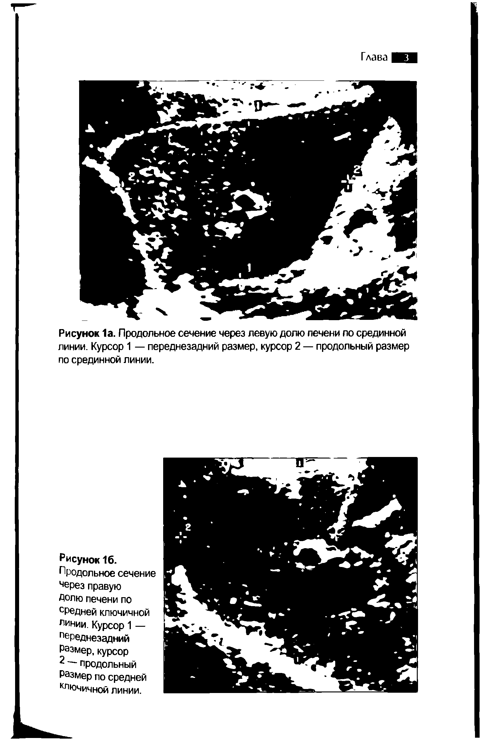 Рисунок 1а. Продольное сечение через левую долю печени по срединной линии. Курсор 1 — переднезадний размер, курсор 2 — продольный размер по срединной линии.