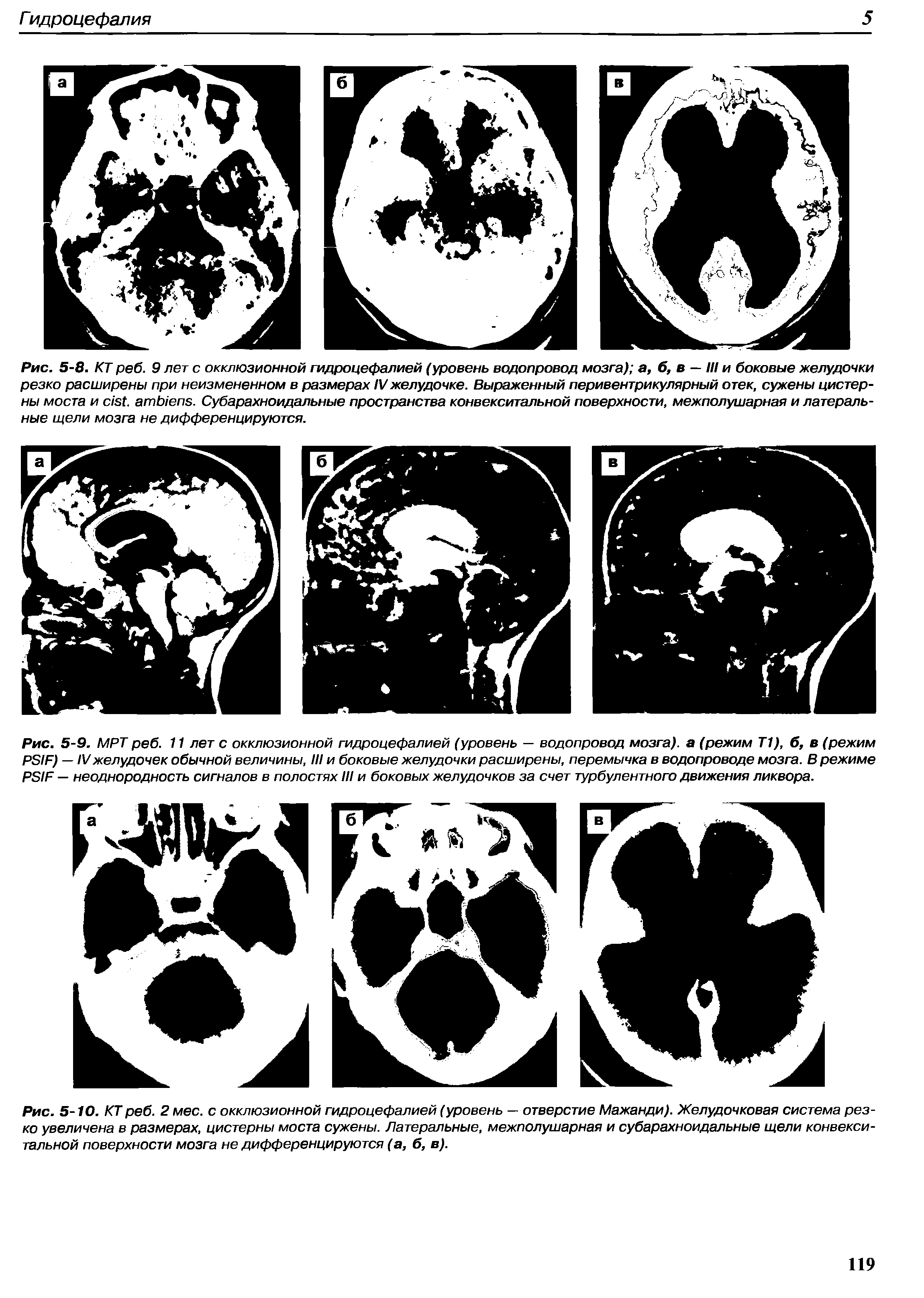 Рис. 5-9. МРТ реб. 11 лет с окклюзионной гидроцефалией (уровень — водопровод мозга), а (режим Т1), б, в (режим PSIF) — IVжелудочек обычной величины, III и боковые желудочки расширены, перемычка в водопроводе мозга. В режиме PSIF — неоднородность сигналов в полостях III и боковых желудочков за счет турбулентного движения ликвора.
