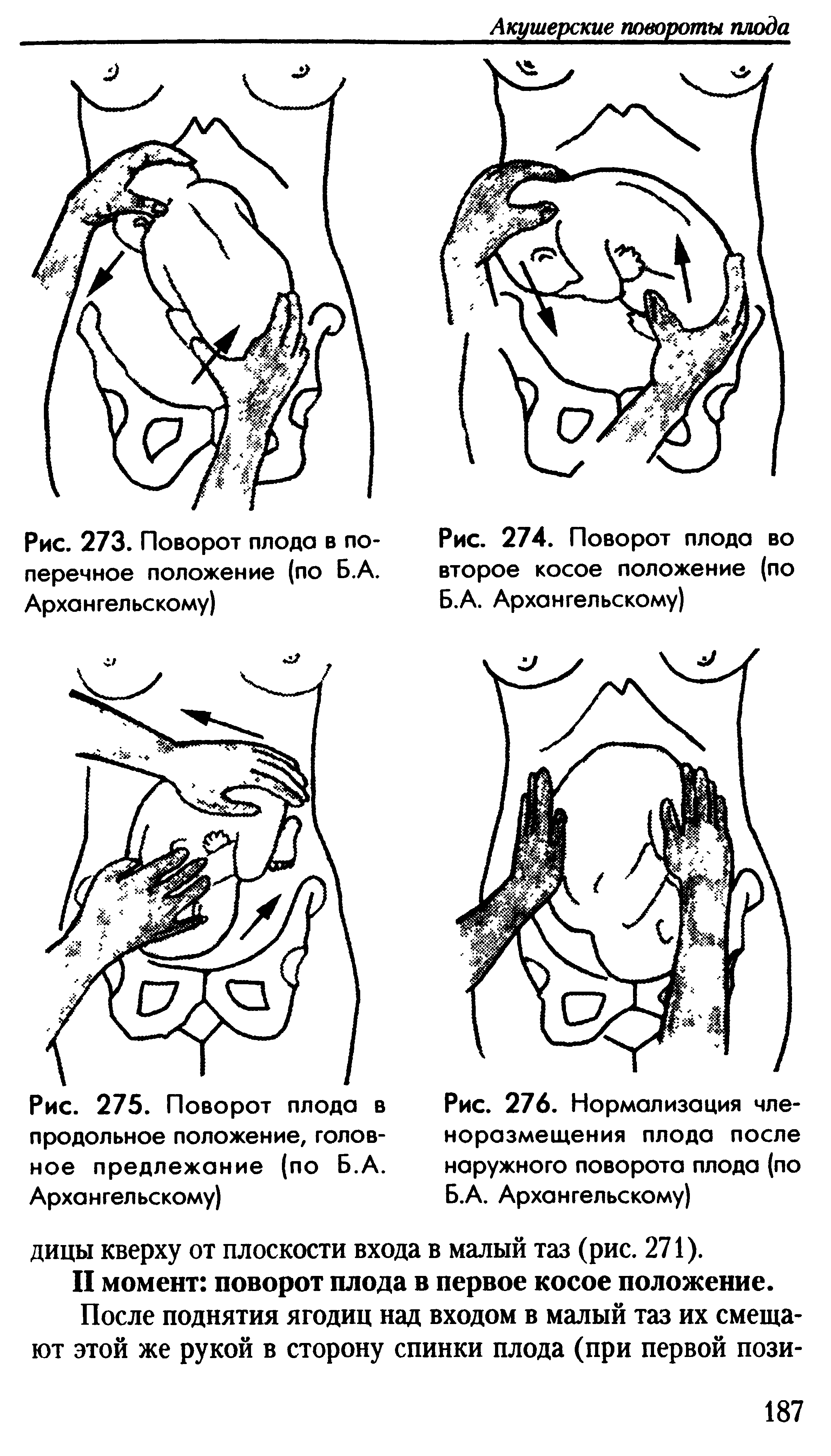 Рис. 276. Нормализация чле-норазмещения плода после наружного поворота плода (по Б.А. Архангельскому)...