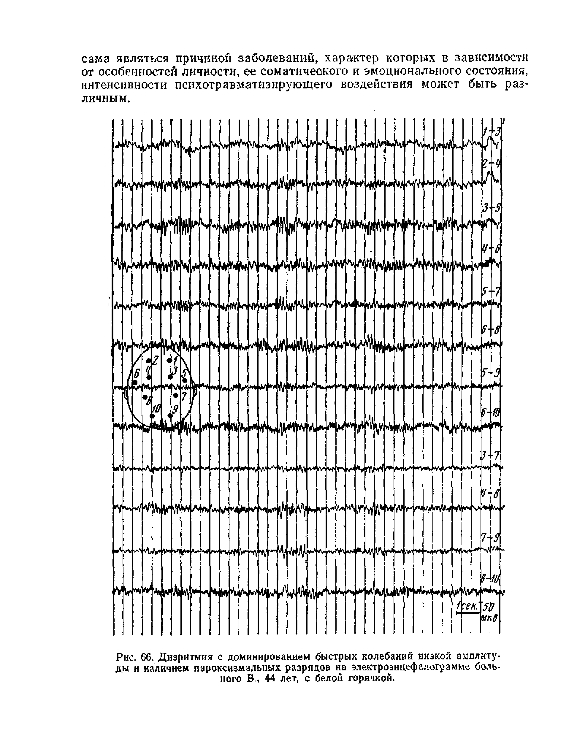 Рис. 66. Дизритмия с доминированием быстрых колебаний низкой амплитуды и наличием пароксизмальных разрядов на электроэнцефалограмме больного В., 44 лет, с белой горячкой.
