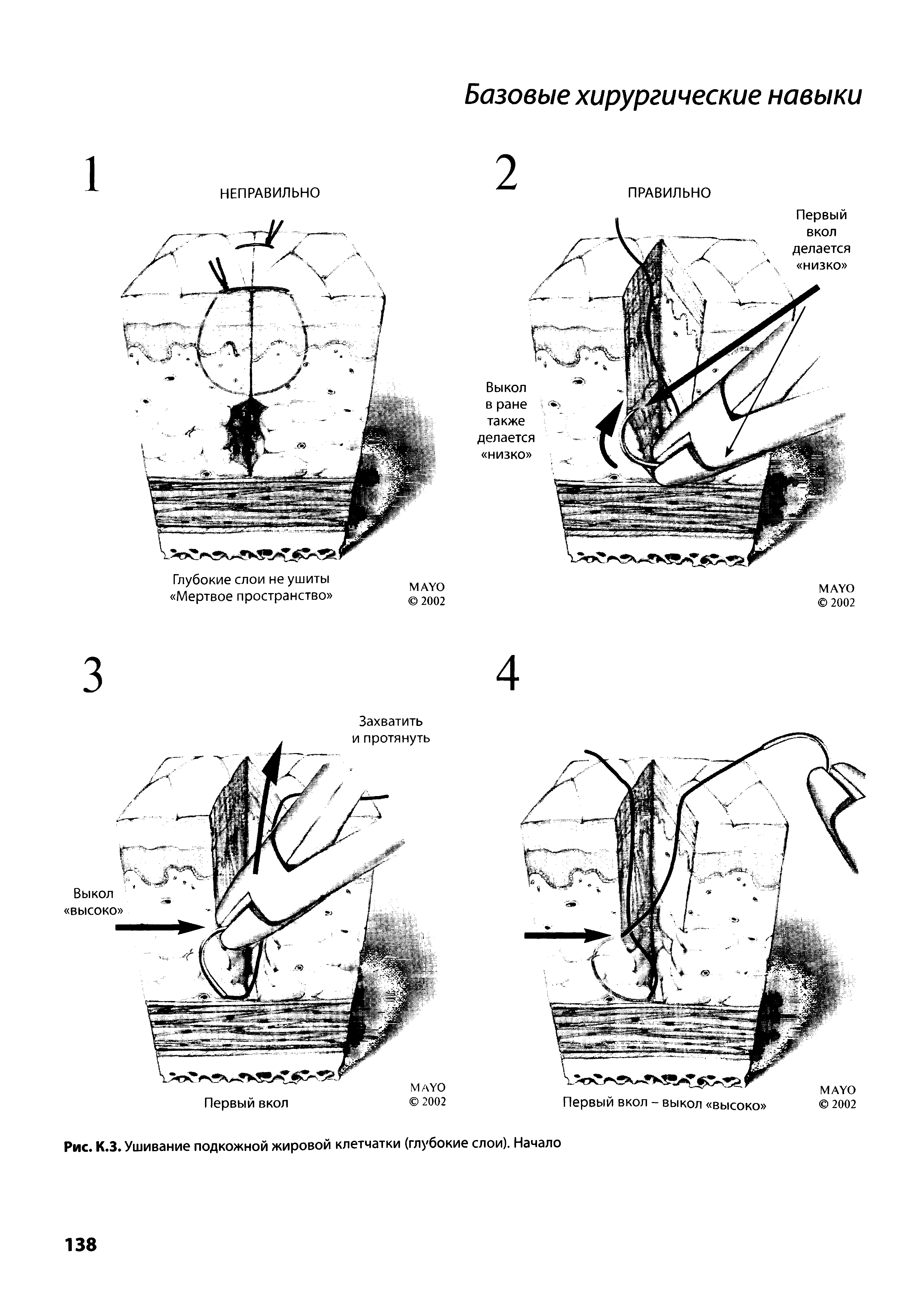 Рис. К.З. Ушивание подкожной жировой клетчатки (глубокие слои). Начало...