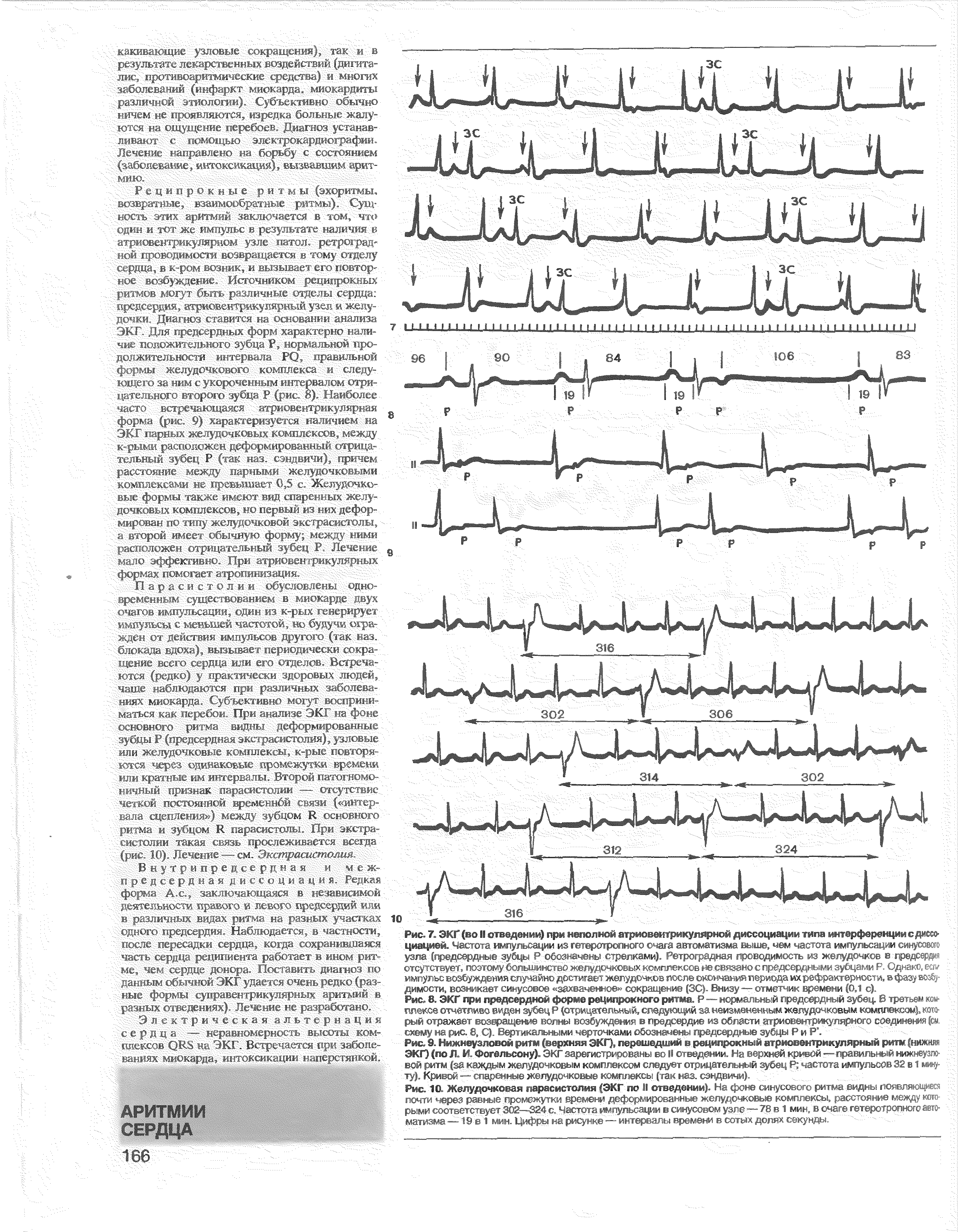 Рис. 7. ЭКГ (во II отведении) при неполной атриовентрикулярной диссоциации типа интерференции с диссоциацией. Частота импульсации из гетеротропного очага автомата - м,< > >, чем частота импульсации синусового...