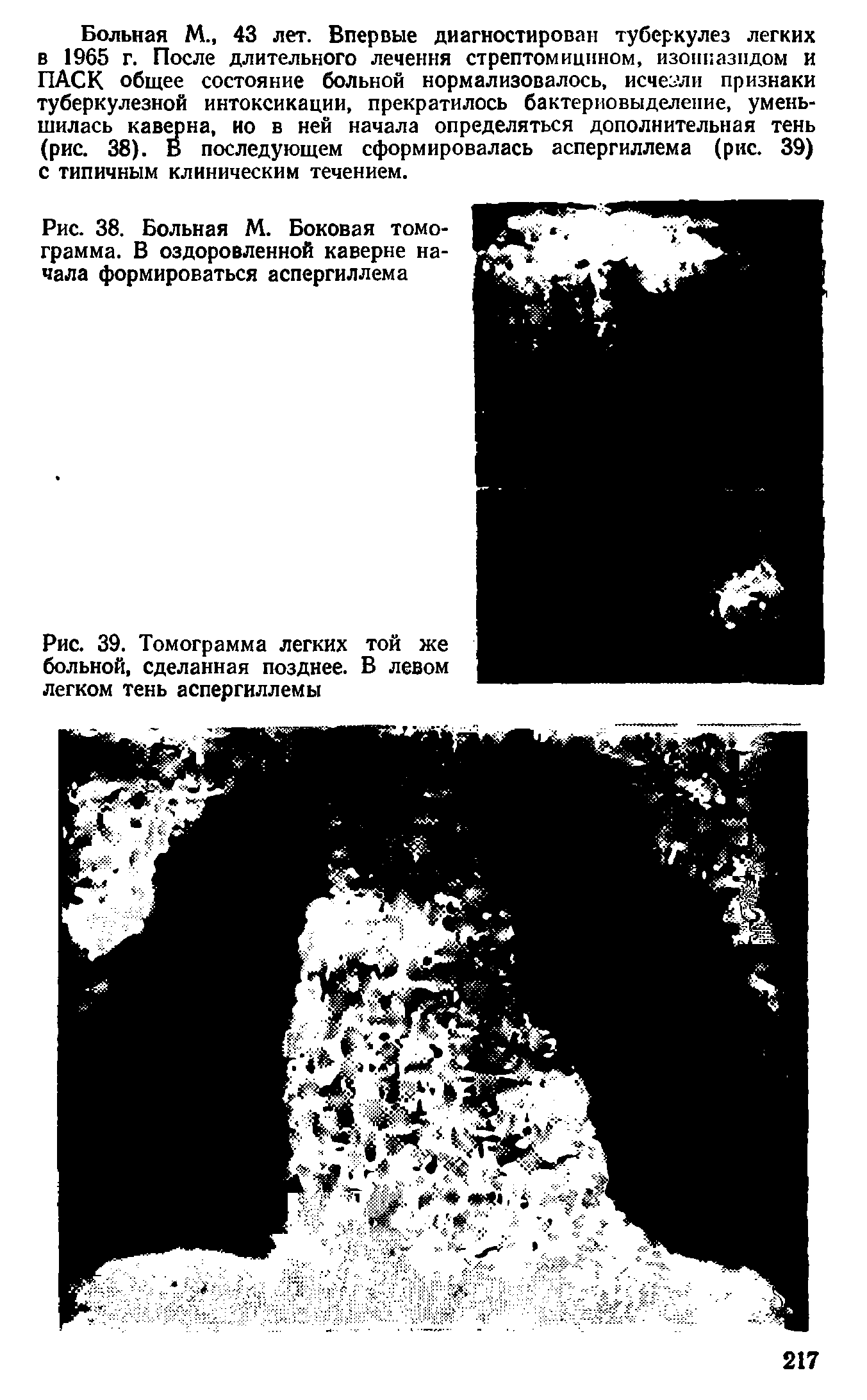 Рис. 39. Томограмма легких той же больной, сделанная позднее. В левом легком тень аспергиллемы...