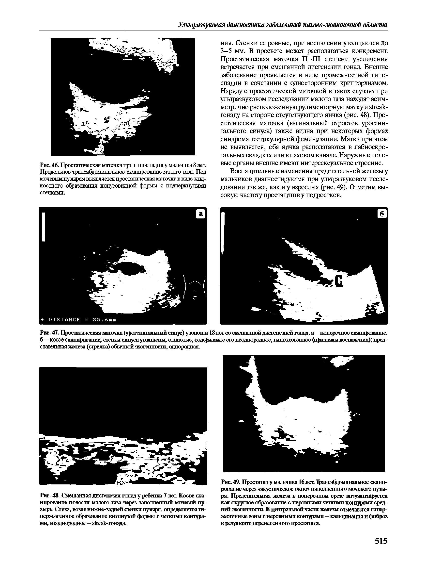 Рис. 47. Простатическая маточка (урогенитальный синус) у юноши 18 лет со смешанной дисгенезией гонад, а—поперечное сканирование, б - косое сканирование стенки синуса утолщены, слоистые, содержимое его неоднородное, гипоэхогенное (признаки воспаления) предстательная железа (стрелка) обычной эхогенности, однородная.
