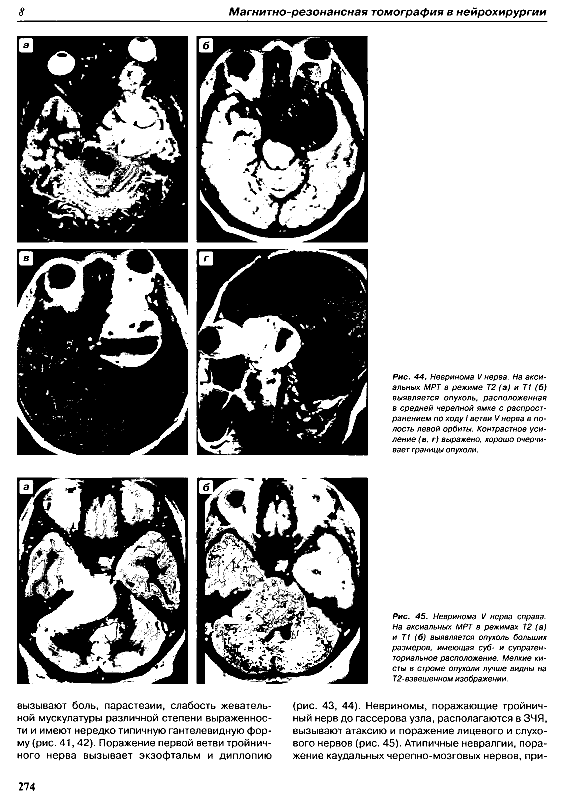 Рис. 45. Невринома V нерва справа. На аксиальных МРТ в режимах Т2 (а) и Т1 (б) выявляется опухоль больших размеров, имеющая суб- и супратенториальное расположение. Мелкие кисты в строме опухоли лучше видны на Т2-взвешенном изображении.