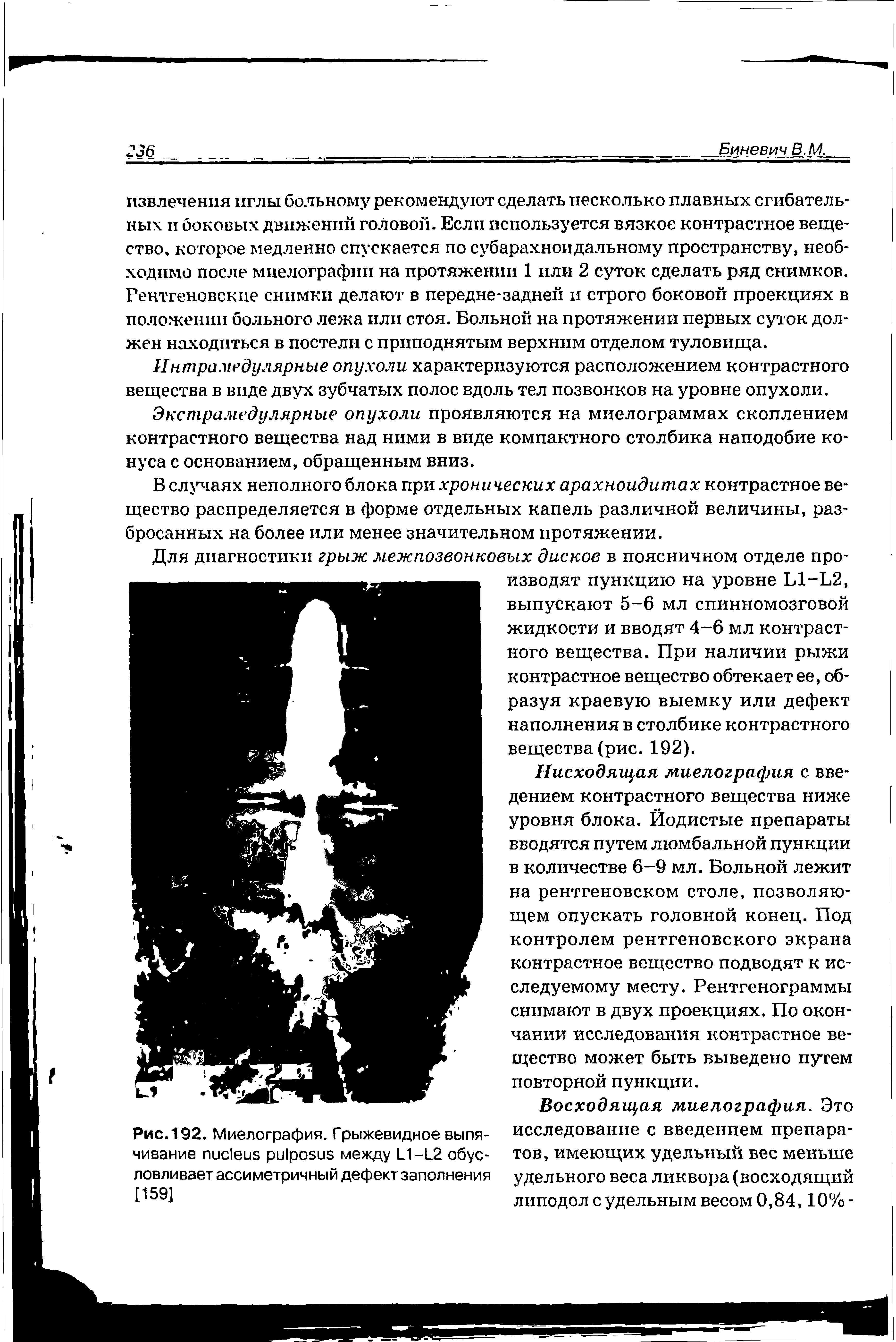 Рис. 192. Миелография. Грыжевидное выпячивание между L1-L2 обусловливает ассиметричный дефект заполнения [159]...