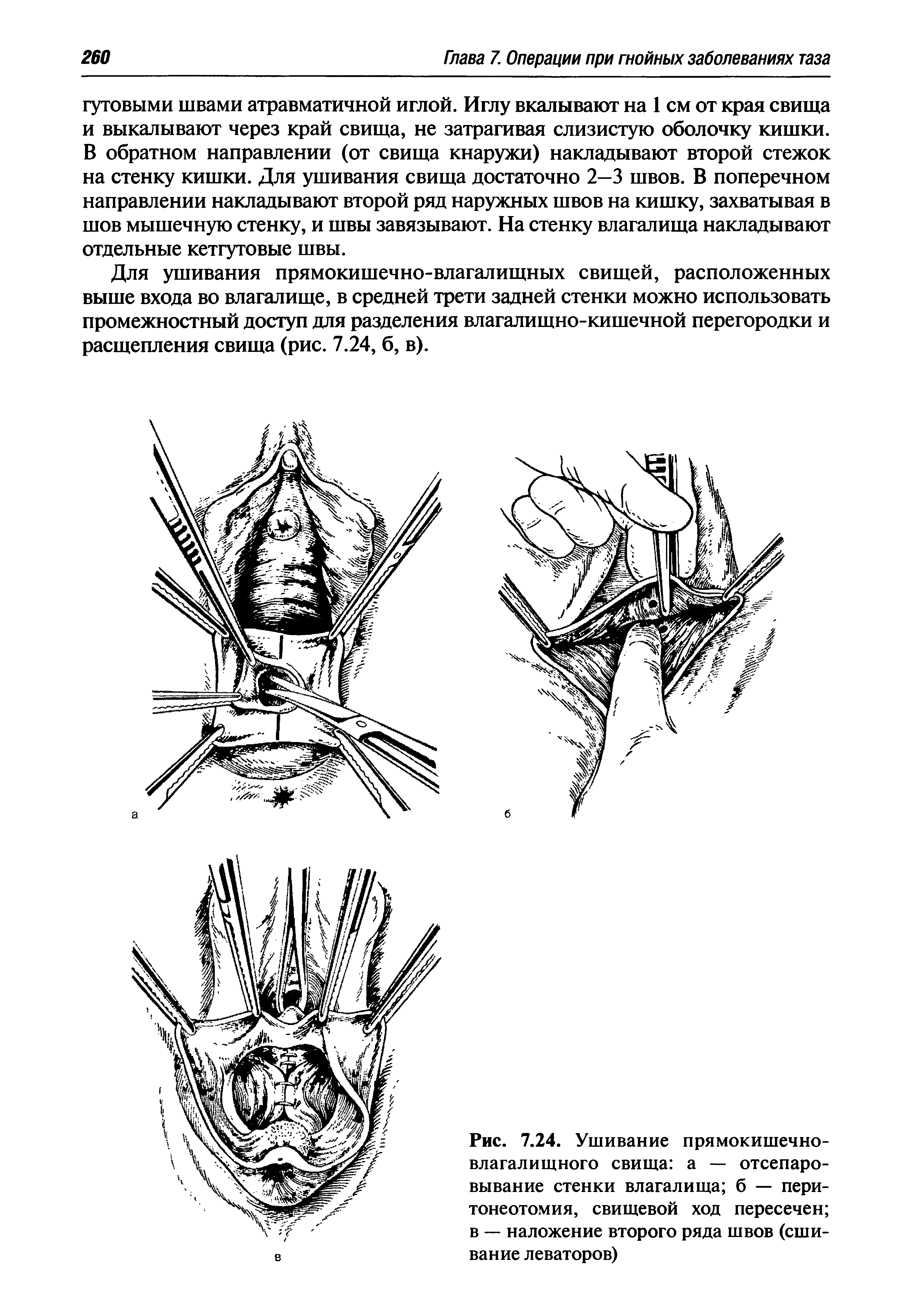 Рис. 7.24. Ушивание прямокишечно-влагалищного свища а — отсепаро-вывание стенки влагалища б — пери-тонеотомия, свищевой ход пересечен в — наложение второго ряда швов (сшивание леваторов)...