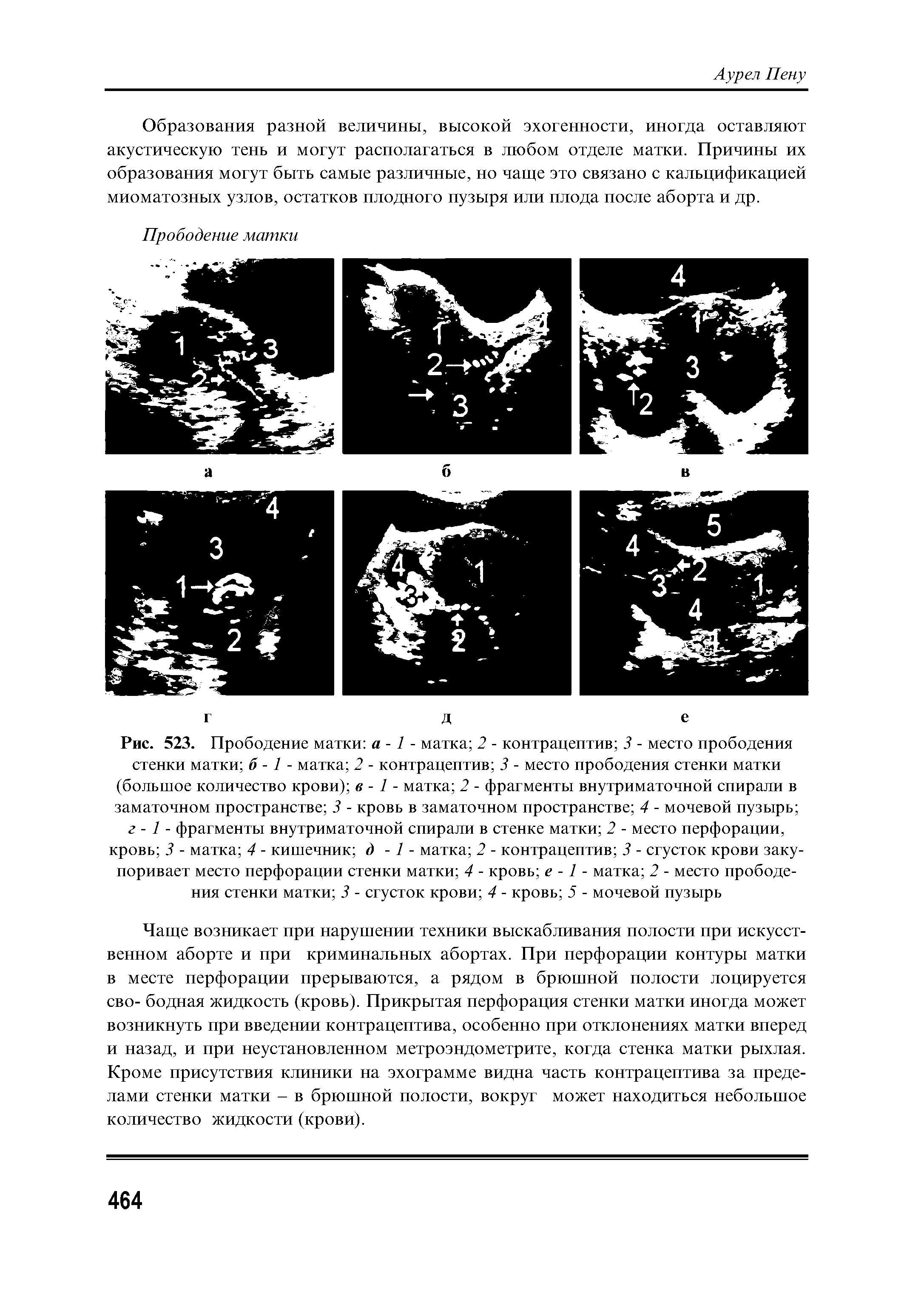 Рис. 523. Прободение матки а -1 - матка 2 - контрацептив 3 - место прободения стенки матки б -1 - матка 2 - контрацептив 3 - место прободения стенки матки (большое количество крови) в - 1 - матка 2 - фрагменты внутриматочной спирали в заматочном пространстве 3 - кровь в заматочном пространстве 4 - мочевой пузырь ...