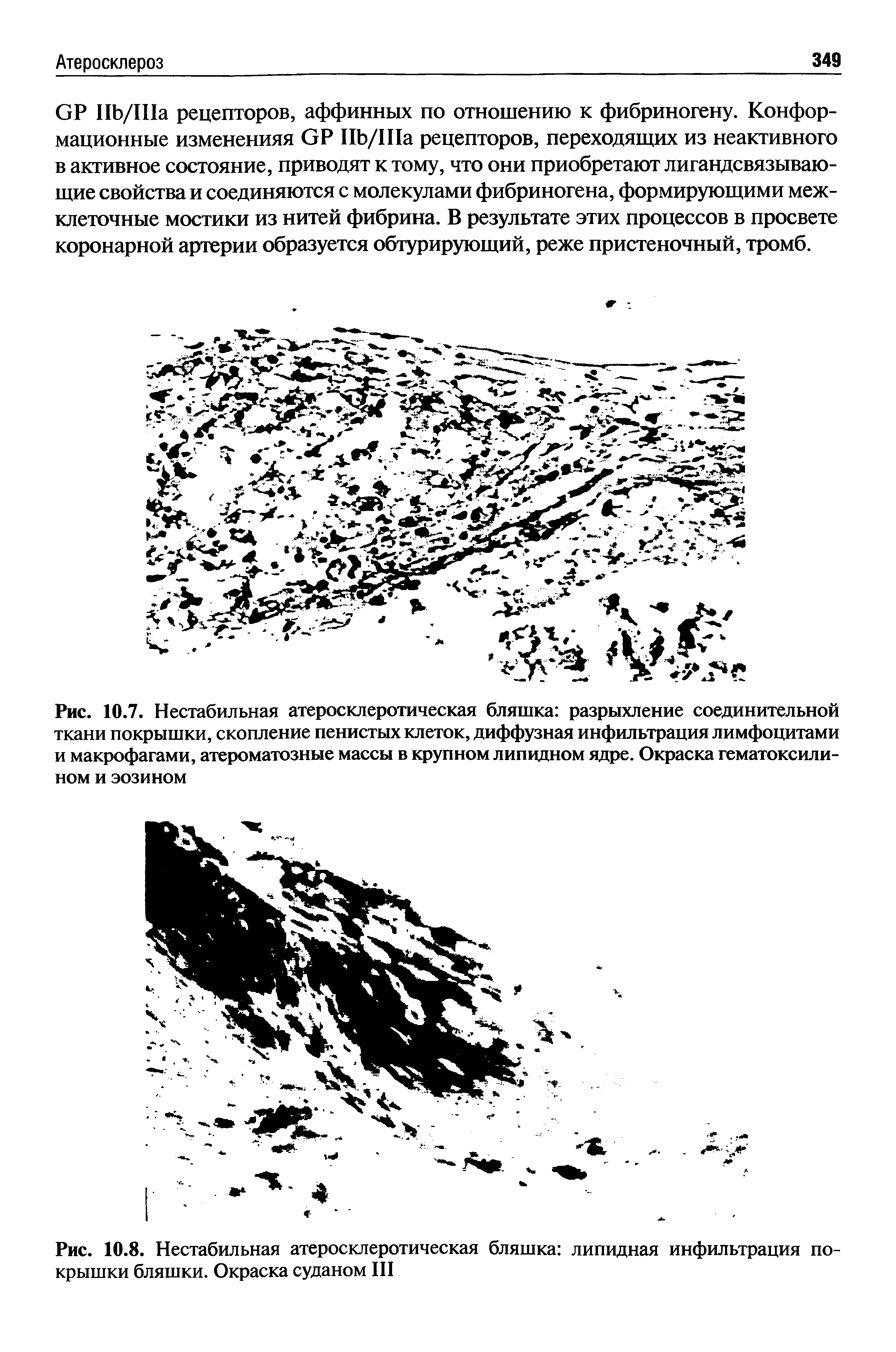 Рис. 10.8. Нестабильная атеросклеротическая бляшка липидная инфильтрация покрышки бляшки. Окраска Суданом III...