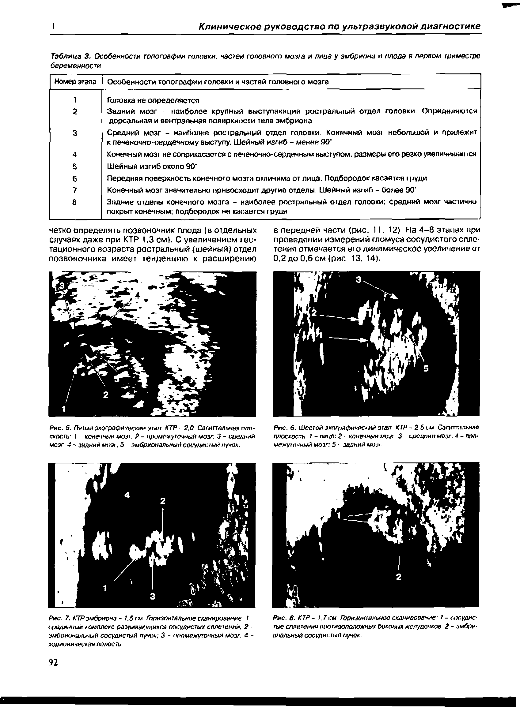 Рис. 8. КТР- 1.7 см Горизонтальноескапиоование 1 -сосудистые сплетении оротияоположных боковых желудочков 2 - эмбриональный сосудиг- тый пучок.