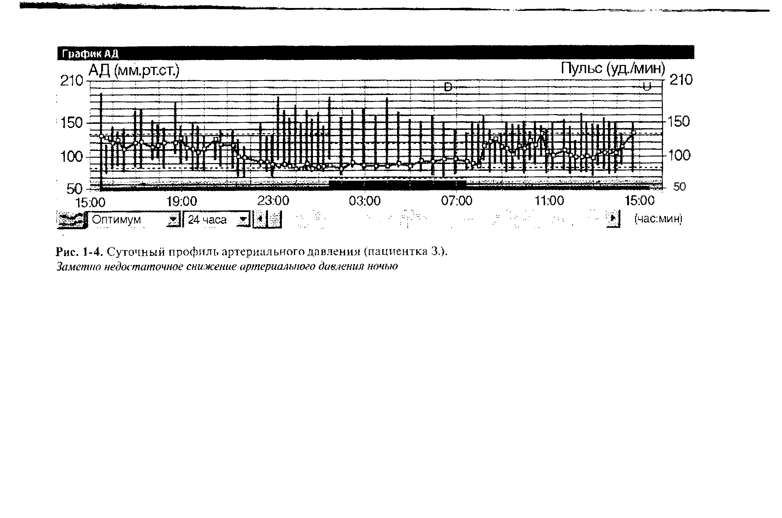 Рис. 1-4, Суточный профиль артериального давления (пациентка 3.). Заметно недостаточное снижение артериального давления ночью...