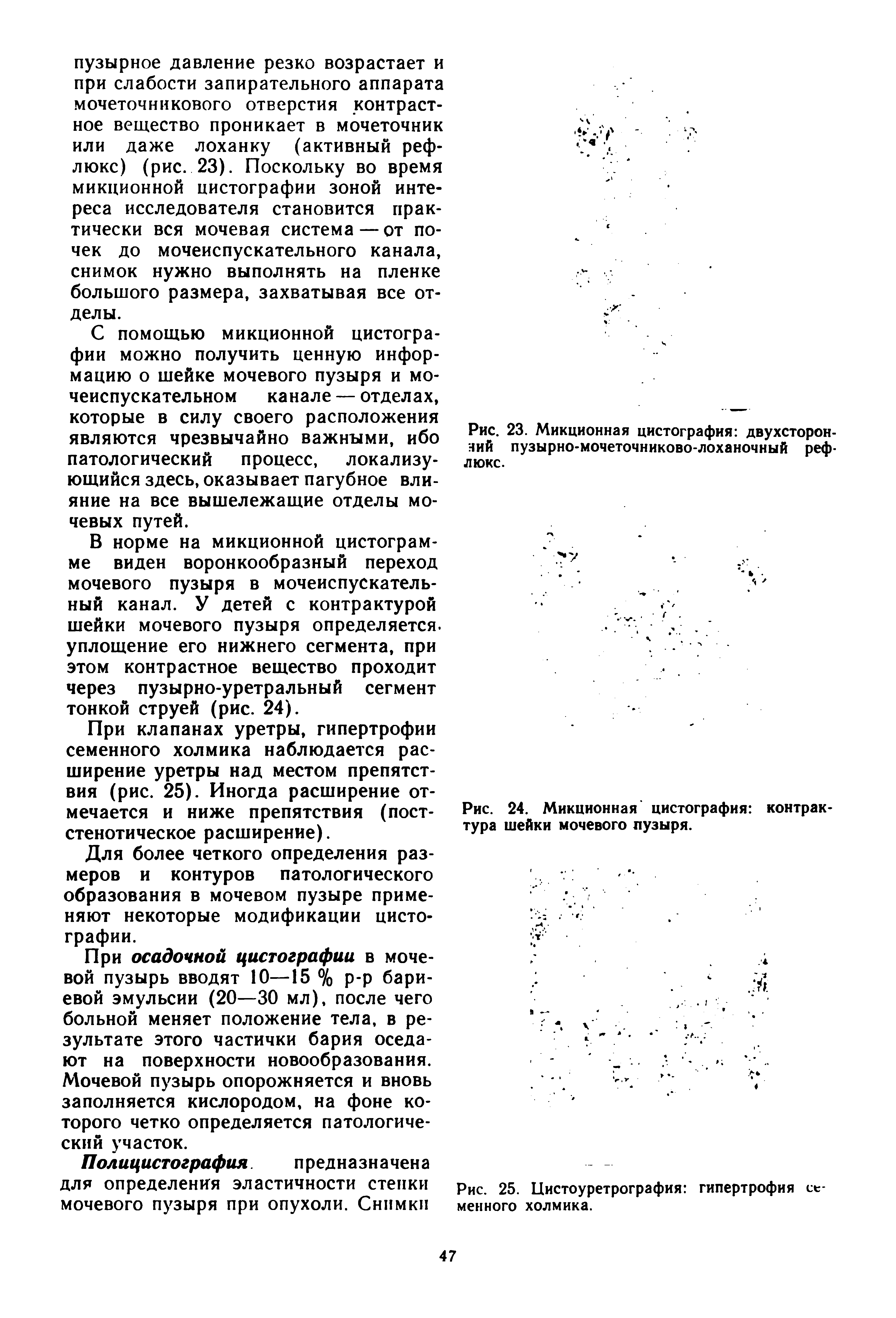 Рис. 24. Микционная цистография контрак тура шейки мочевого пузыря.