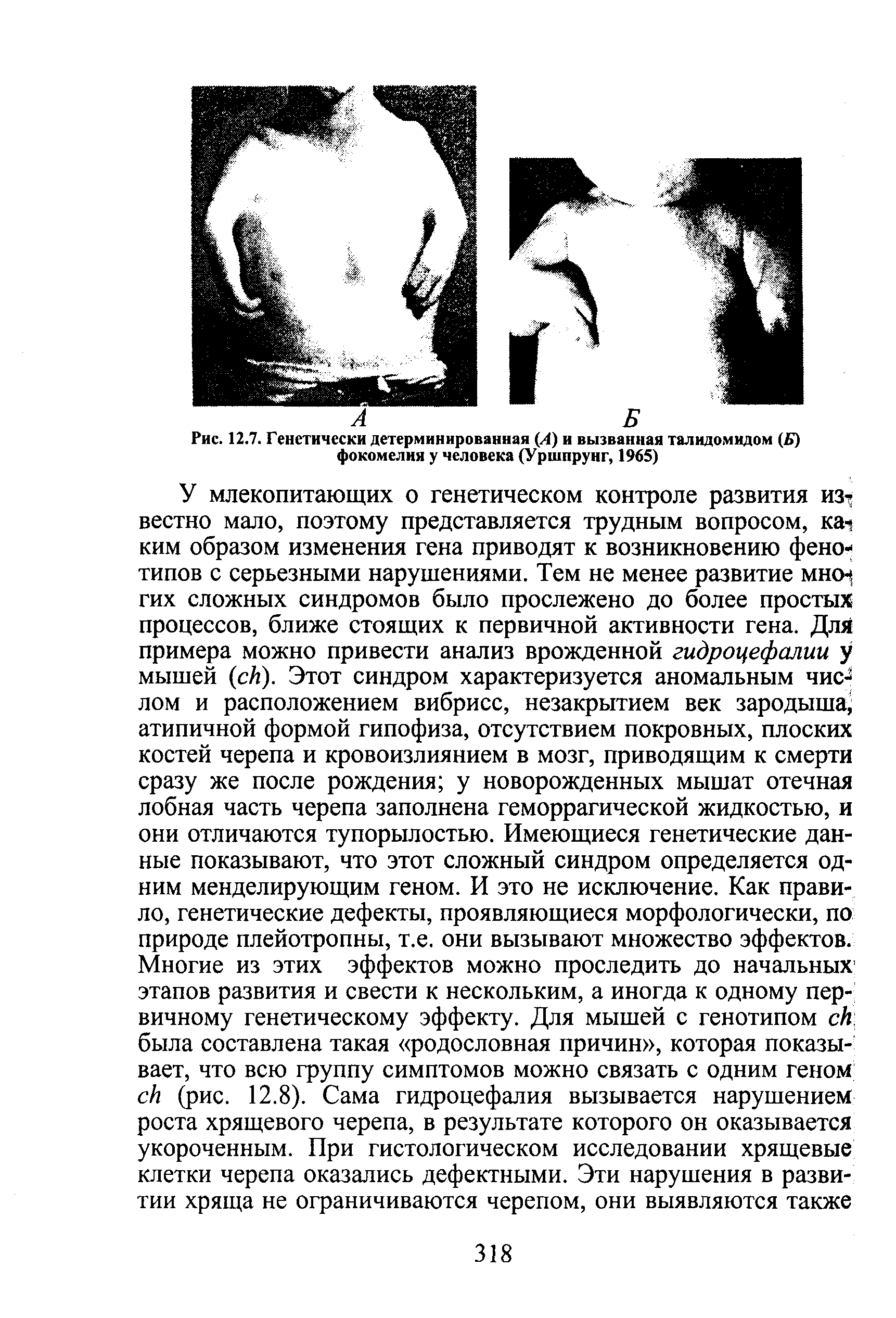 Рис. 12.7. Генетически детерминированная (А) и вызванная талидомидом (Б) фокомелия у человека (Уршпрунг, 1965)...