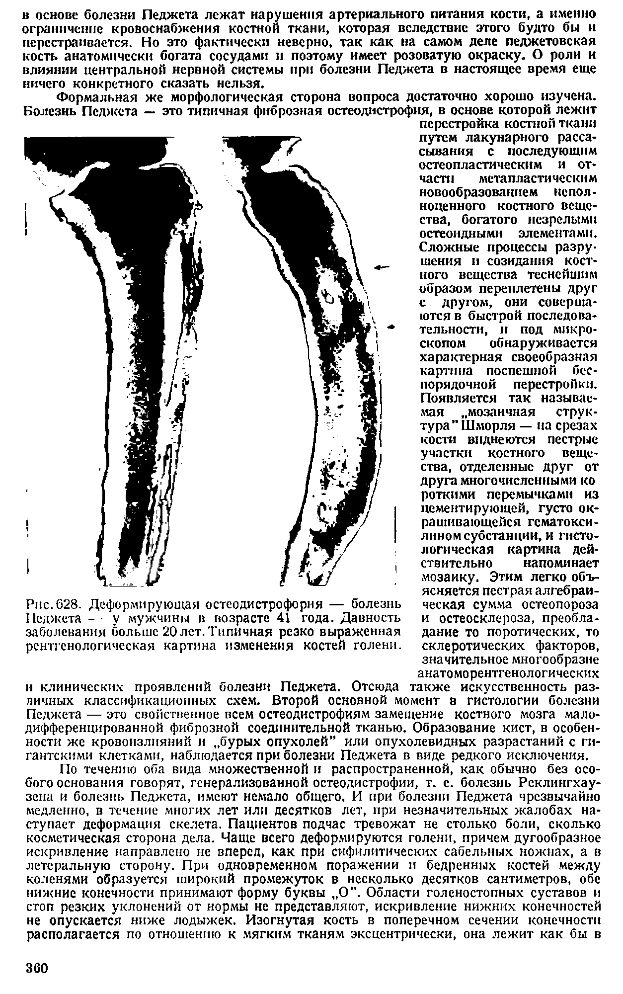 Рис.628. Деформирующая остеодистрофорня — болезнь Педжета — у мужчины в возрасте 41 года. Давность заболевания больше 20 лет. Типичная резко выраженная рентгенологическая картина изменения костей голени.