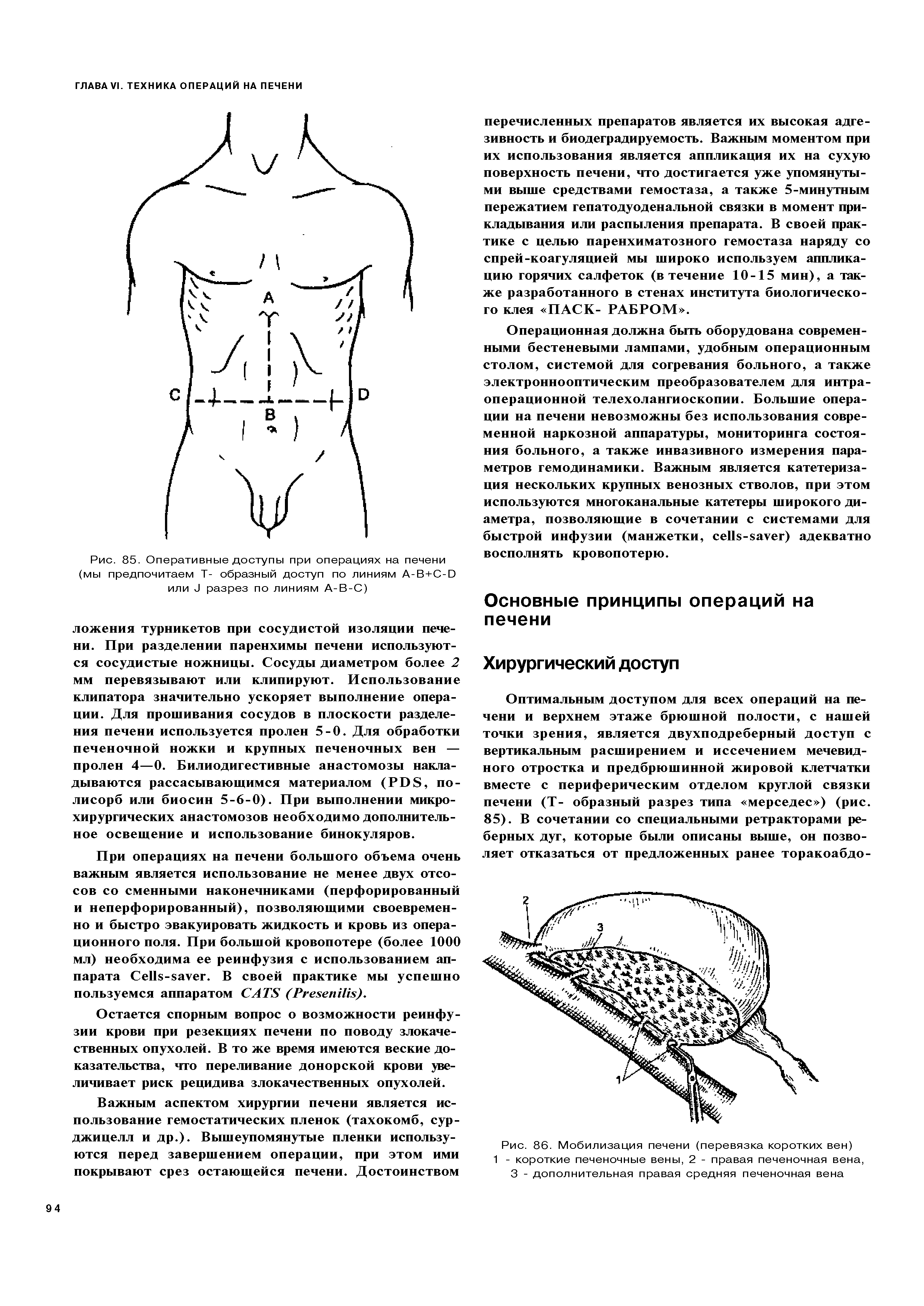 Рис. 85. Оперативные доступы при операциях на печени (мы предпочитаем Т- образный доступ по линиям А-В+С-Э или 8 разрез по линиям А-В-С)...