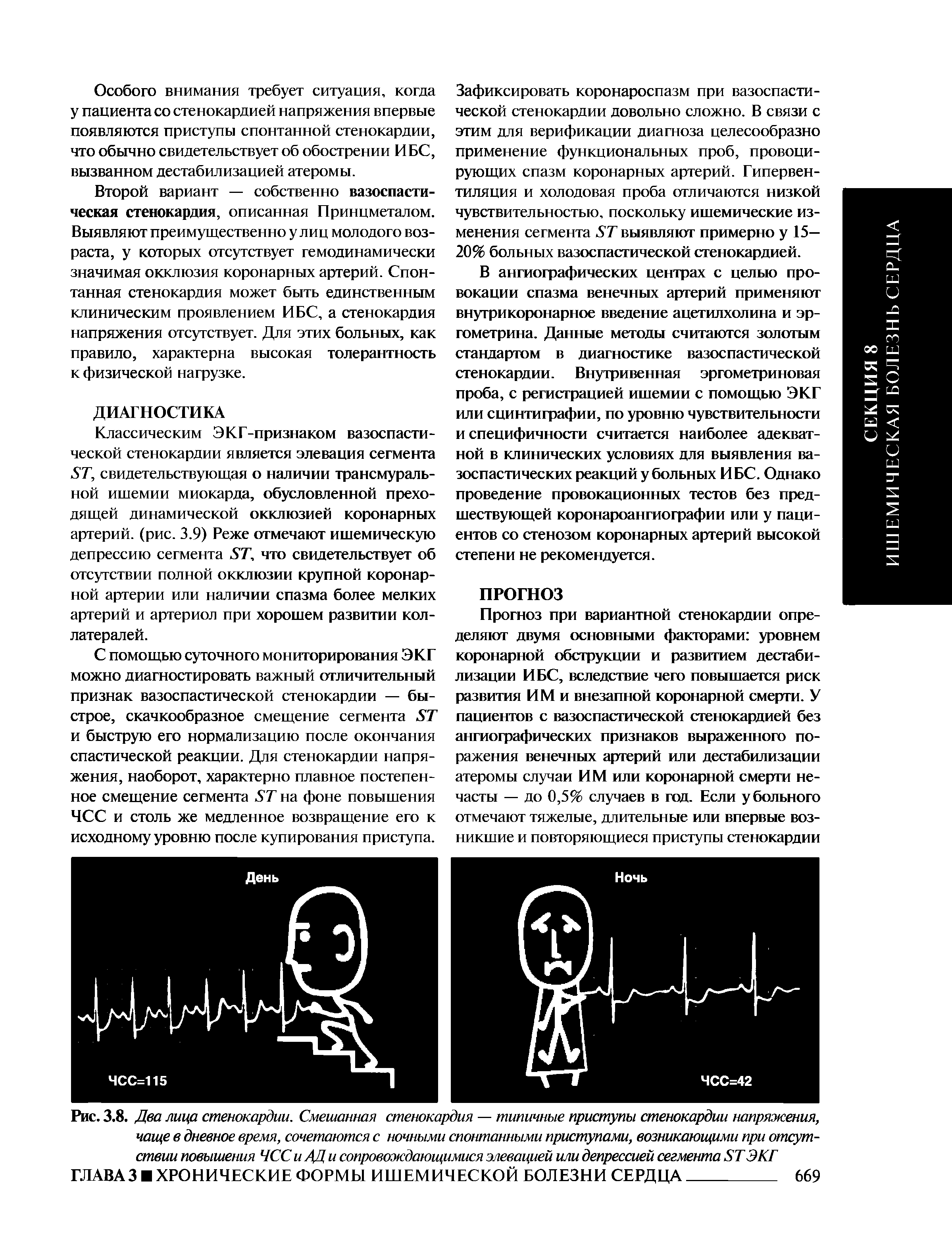 Рис. 3.8. Два лица стенокардии. Смешанная стенокардия — типичные приступы стенокардии напряжения, чаще в дневное время, сочетаются с ночными спонтанными приступами, возникающими при отсутствии повышения ЧСС и АД и сопровождающимися элевацией или депрессией сегмента КТ ЭКГ...