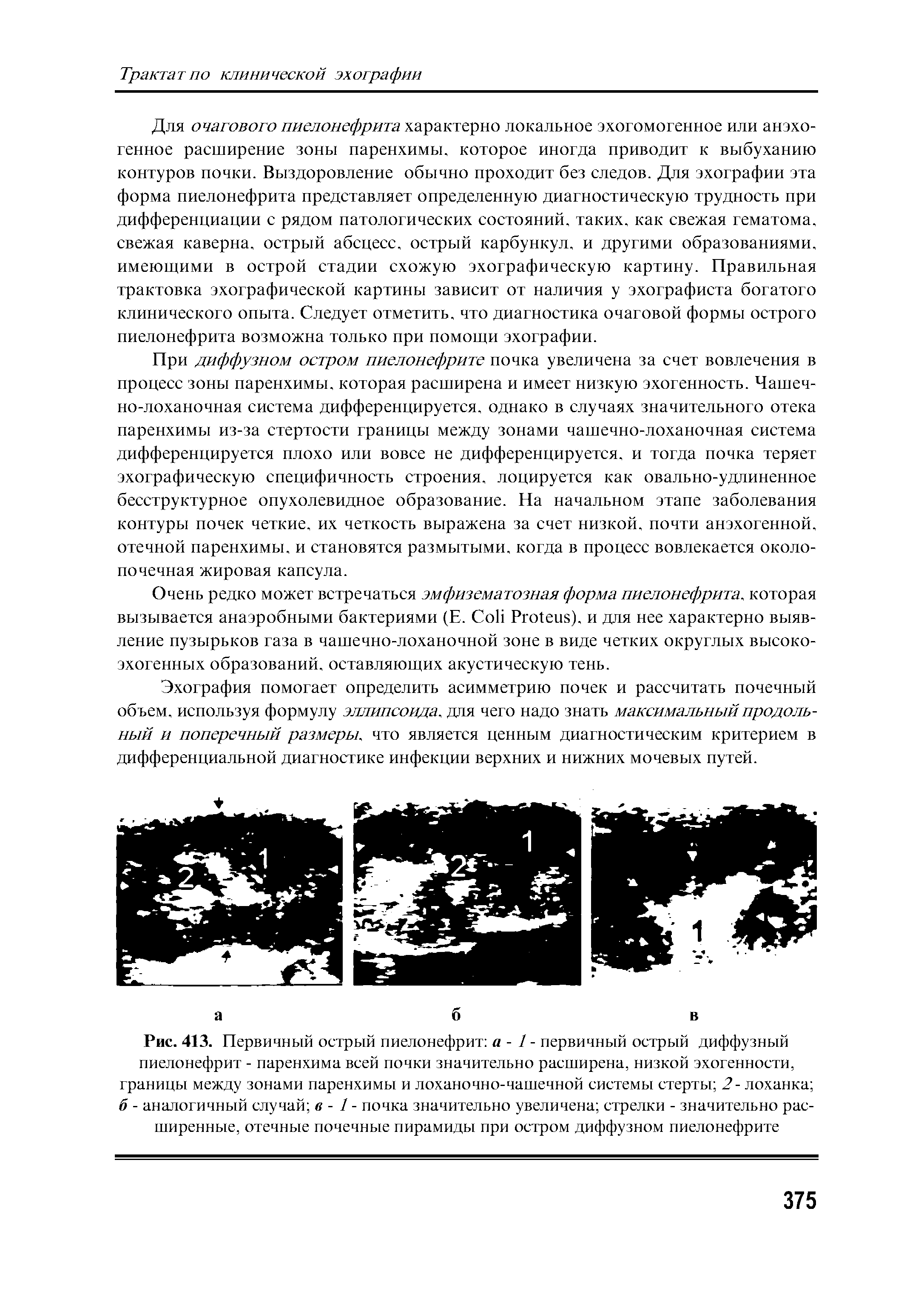 Рис. 413. Первичный острый пиелонефрит а - 1 - первичный острый диффузный пиелонефрит - паренхима всей почки значительно расширена, низкой эхогенности, границы между зонами паренхимы и лоханочно-чашечной системы стерты 2- лоханка б - аналогичный случай в - 1 - почка значительно увеличена стрелки - значительно расширенные, отечные почечные пирамиды при остром диффузном пиелонефрите...