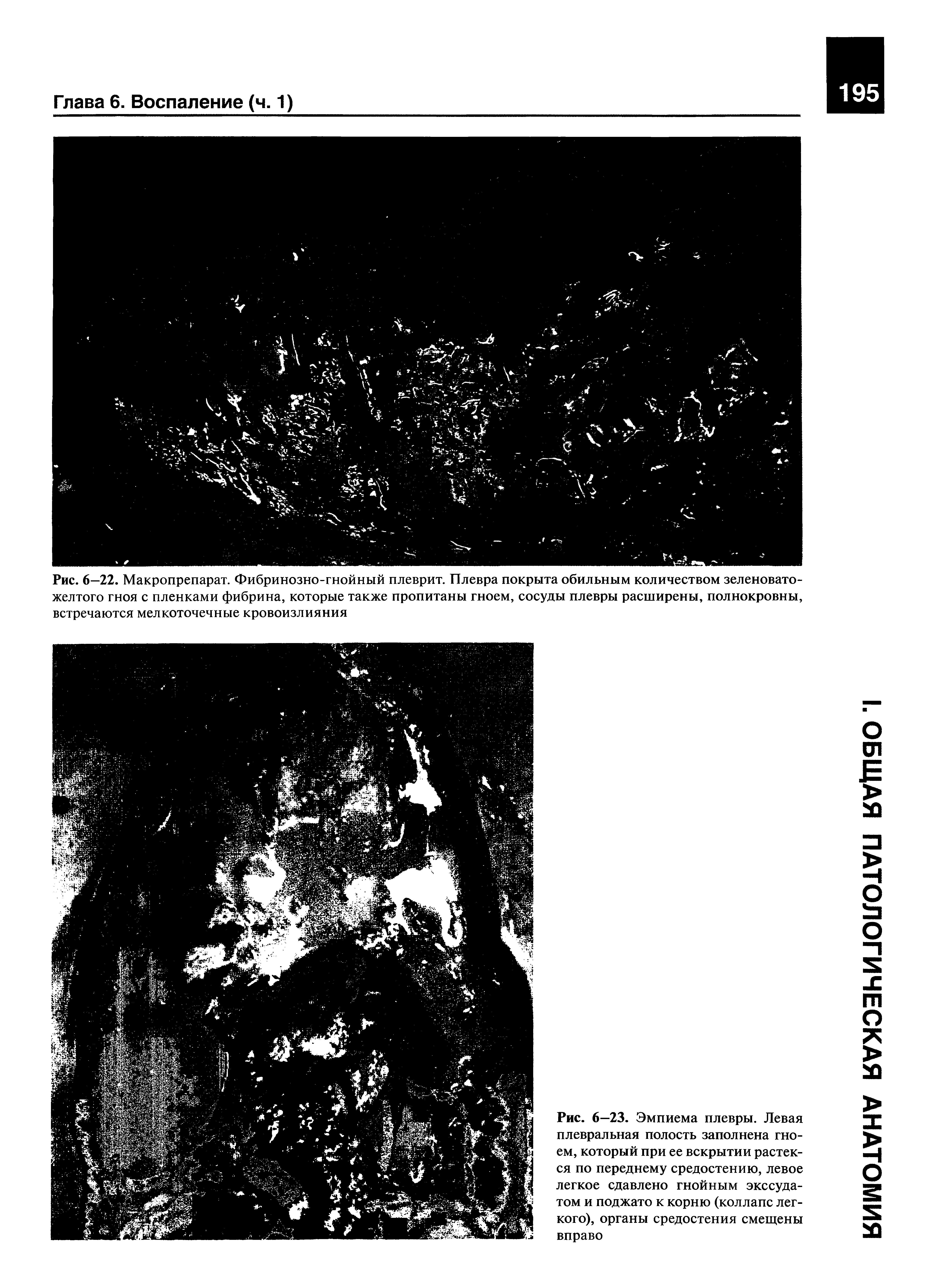 Рис. 6—22. Макропрепарат. Фибринозно-гнойный плеврит. Плевра покрыта обильным количеством зеленовато-желтого гноя с пленками фибрина, которые также пропитаны гноем, сосуды плевры расширены, полнокровны, встречаются мелкоточечные кровоизлияния...