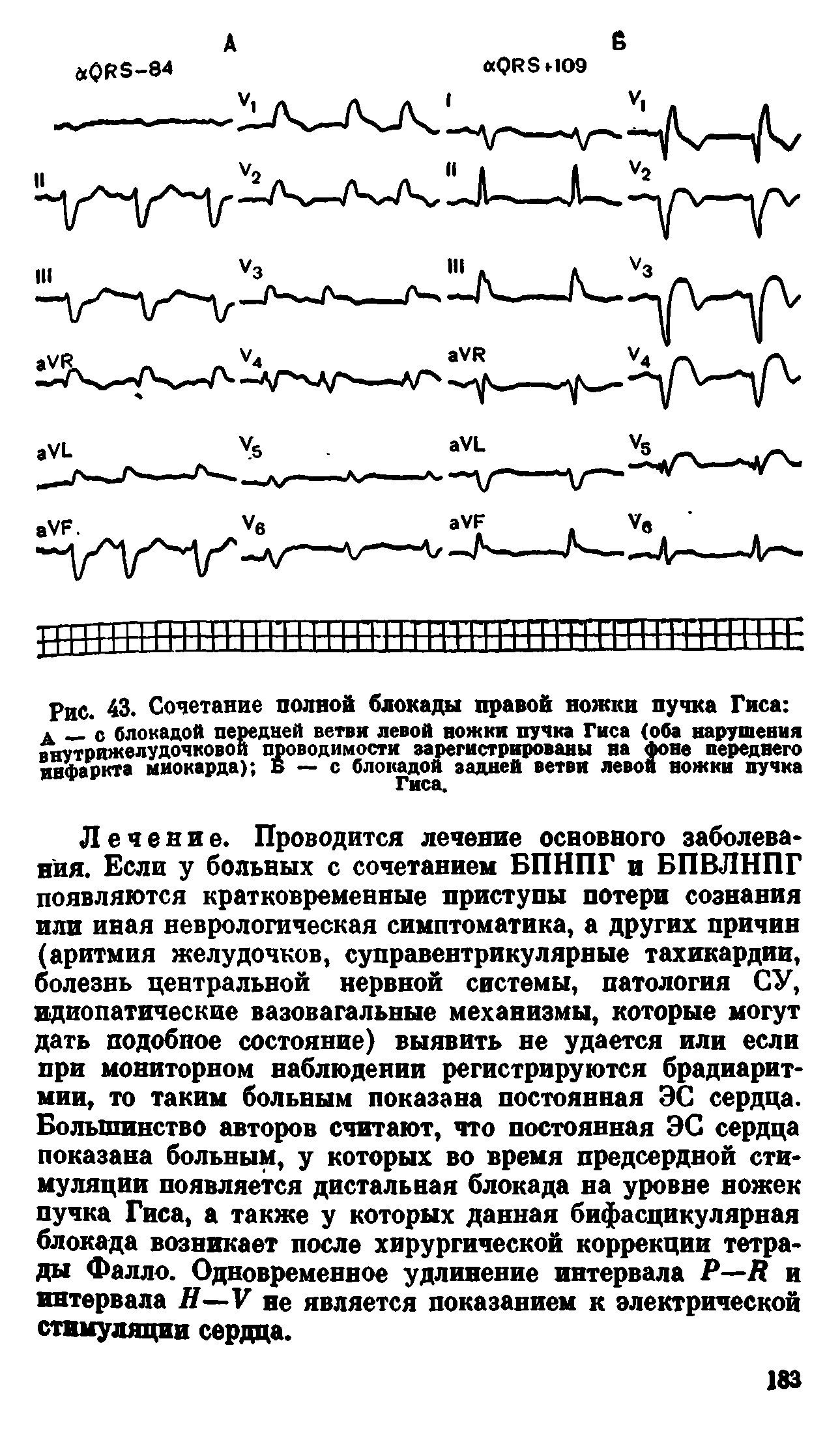 Рис. 43. Сочетание полной блокада правой ножки пучка Гиса А с блокадой передней ветви левой ножки пучка Гиса (оба нарушения...