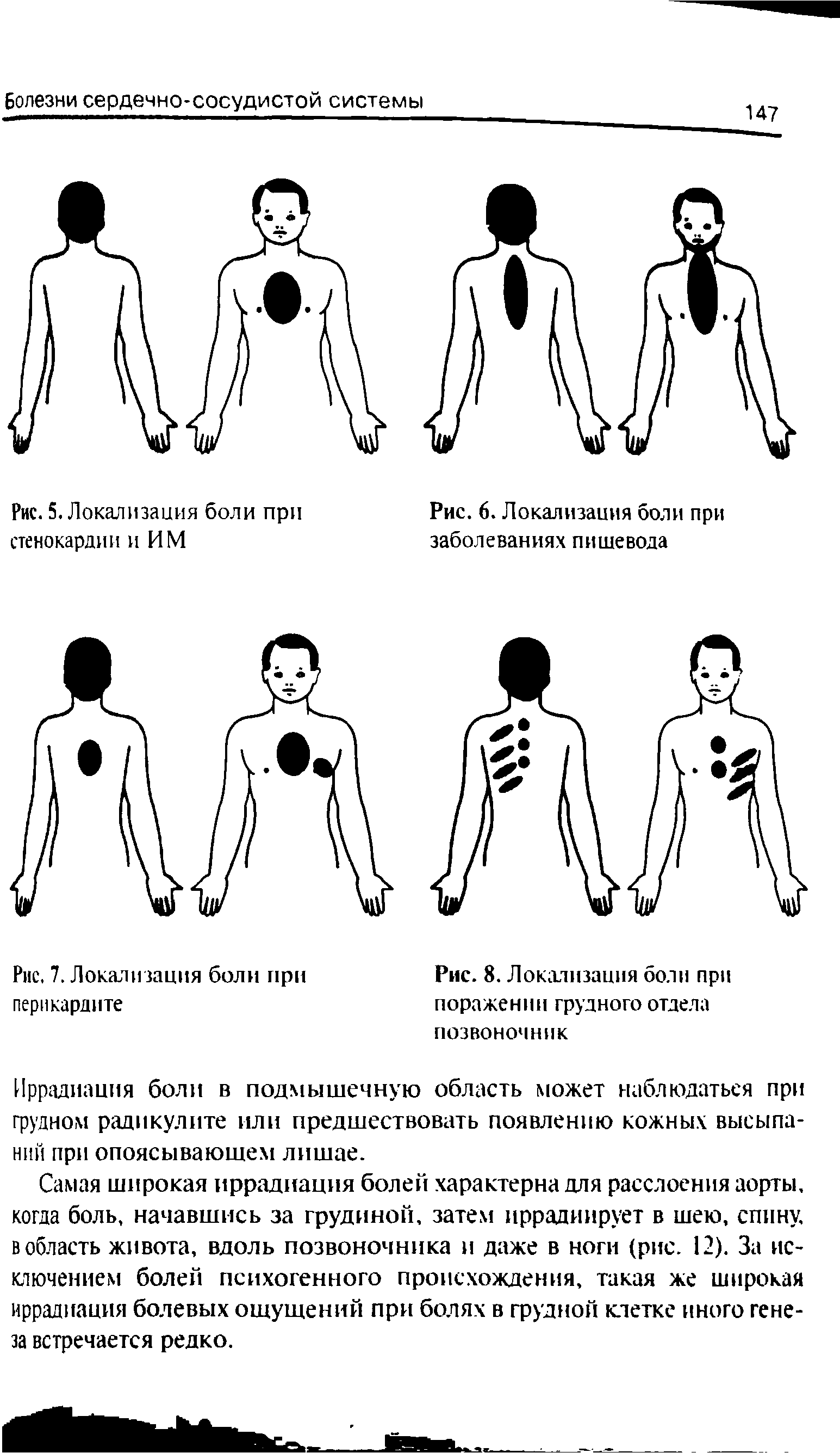 Рис. 8. Локализация боли при поражении грудного отдела позвоночник...