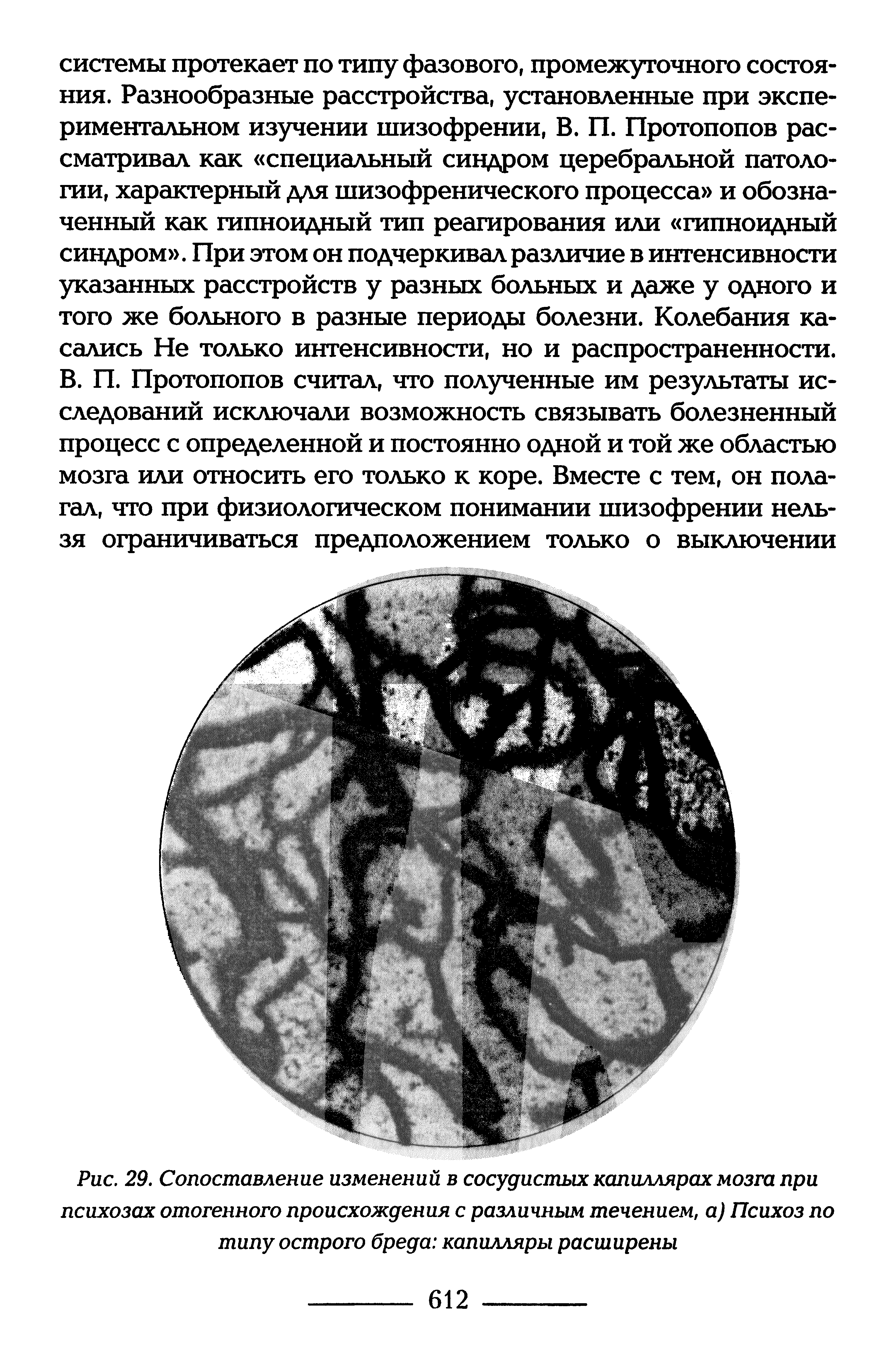 Рис. 29. Сопоставление изменений в сосудистых капиллярах мозга при психозах отогенного происхождения с различным течением, а) Психоз по типу острого бреда капилляры расширены...