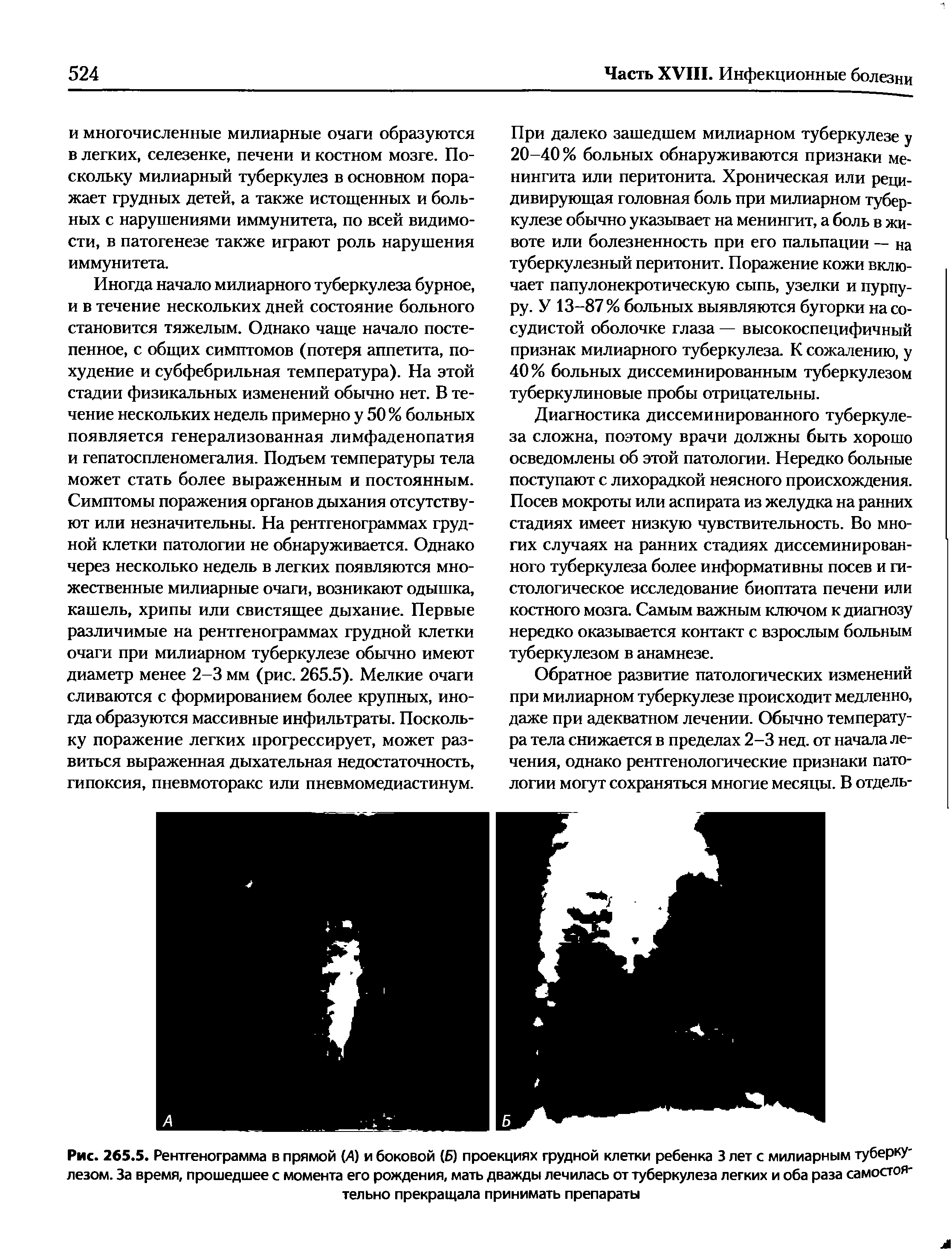 Рис. 265.5. Рентгенограмма в прямой (Д) и боковой (Б) проекциях грудной клетки ребенка 3 лет с милиарным туберку-лезом. За время, прошедшее с момента его рождения, мать дважды лечилась от туберкулеза легких и оба раза самостоятельно прекращала принимать препараты...