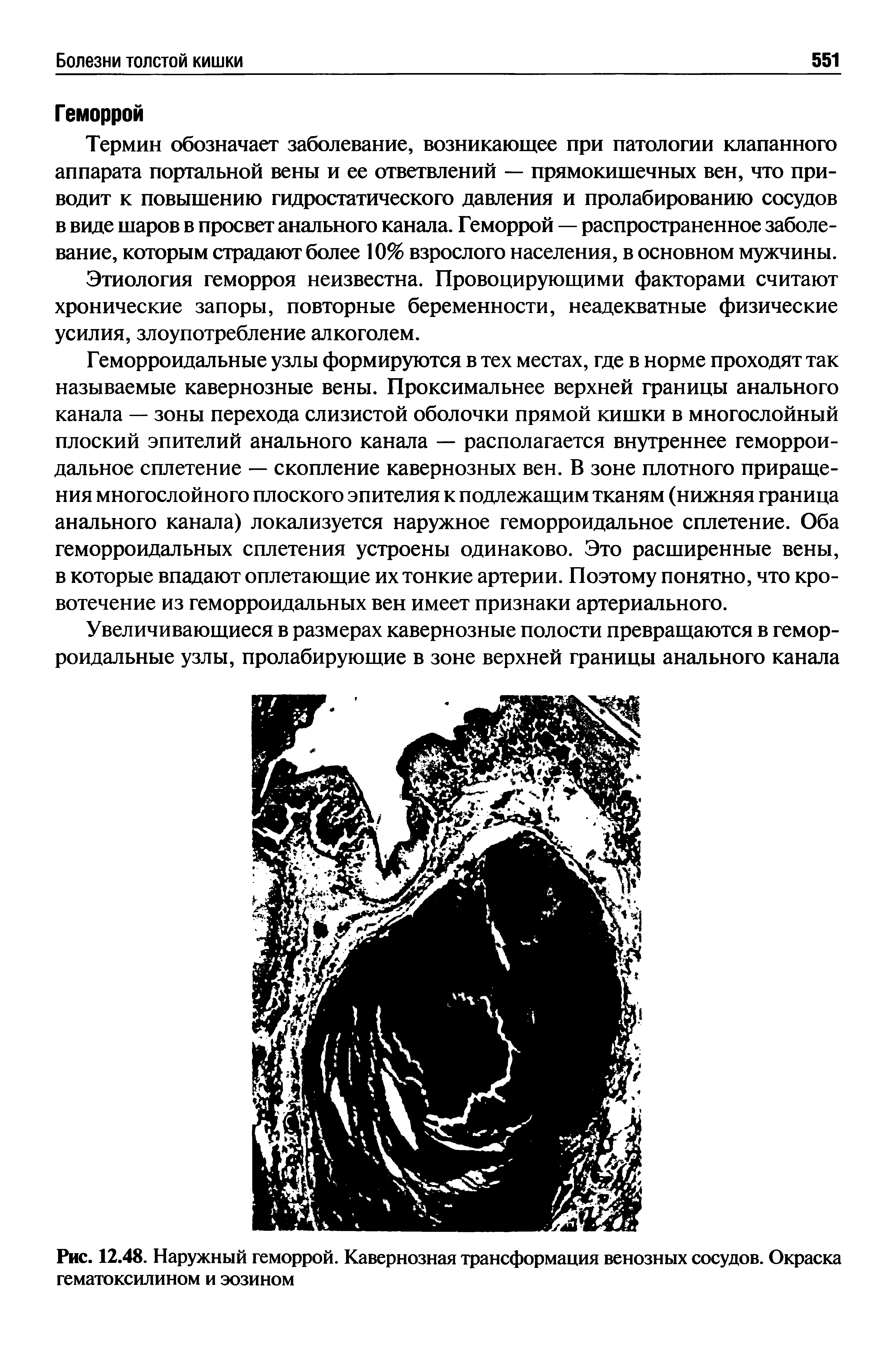 Рис. 12.48. Наружный геморрой. Кавернозная трансформация венозных сосудов. Окраска гематоксилином и эозином...