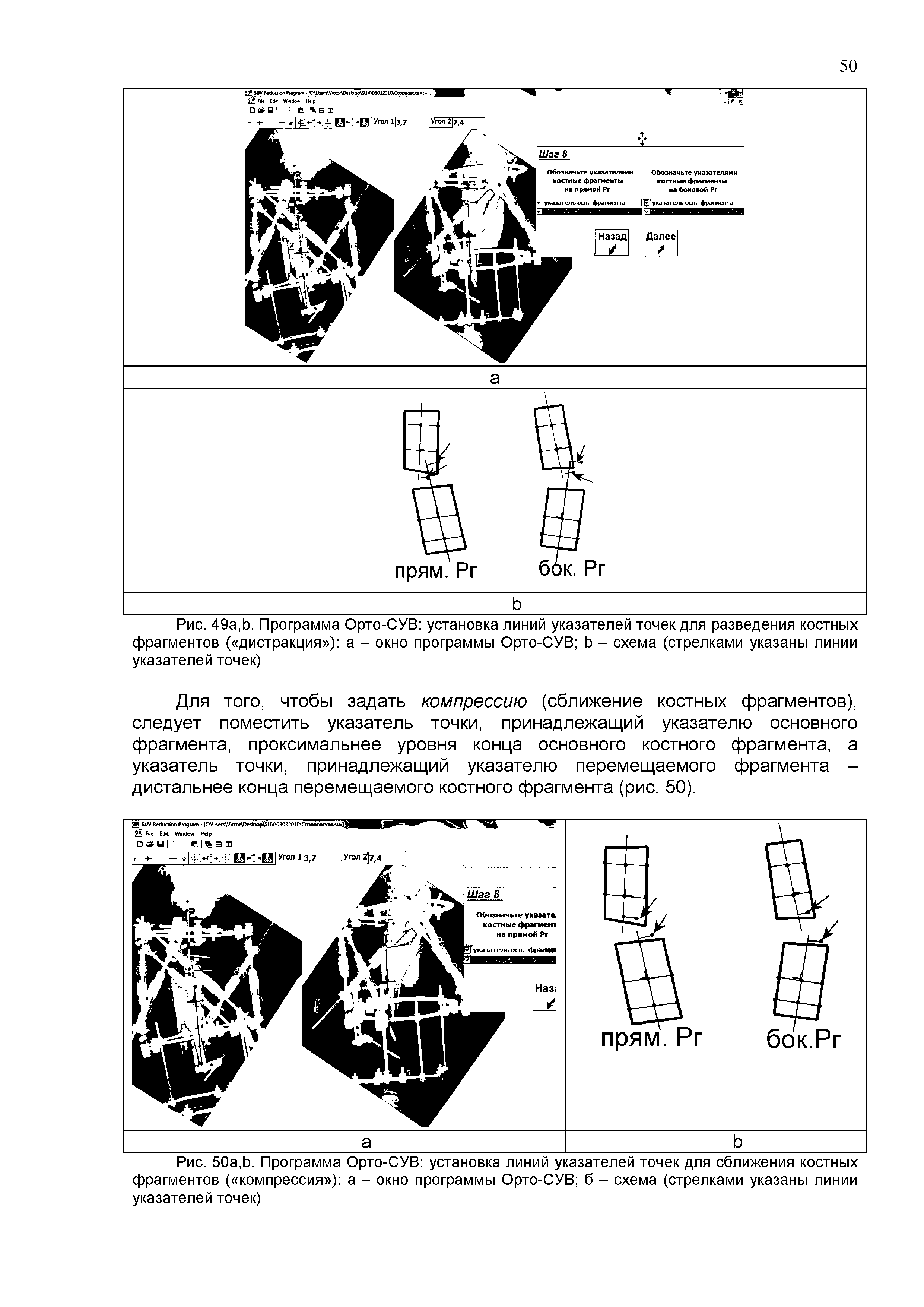 Рис. 50а,Ь. Программа Орто-СУВ установка линий указателей точек для сближения костных фрагментов ( компрессия ) а - окно программы Орто-СУВ б - схема (стрелками указаны линии указателей точек)...
