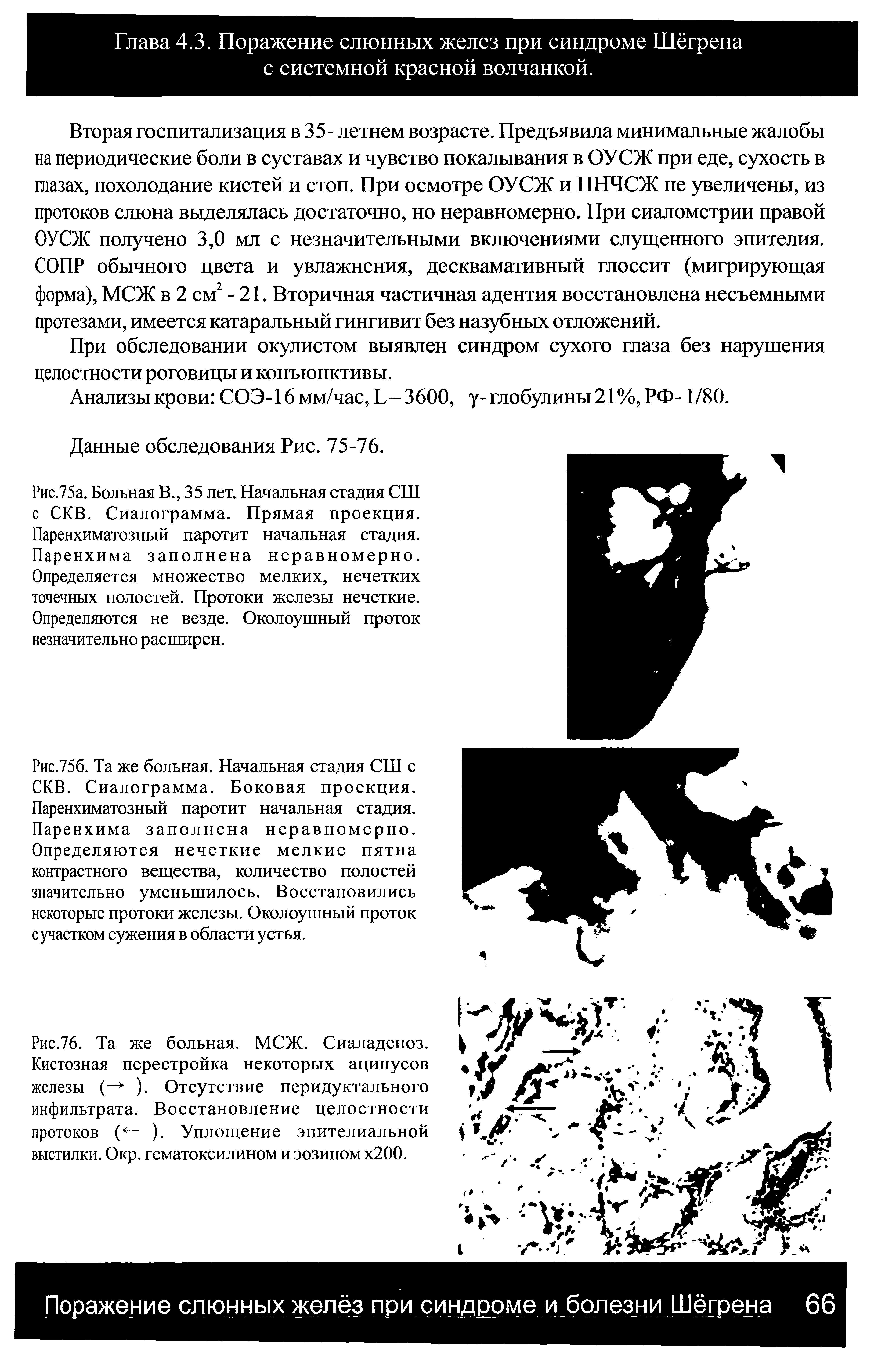 Рис.75б. Та же больная. Начальная стадия СШ с СКВ. Сиалограмма. Боковая проекция. Паренхиматозный паротит начальная стадия. Паренхима заполнена неравномерно. Определяются нечеткие мелкие пятна контрастного вещества, количество полостей значительно уменьшилось. Восстановились некоторые протоки железы. Околоушный проток с участком сужения в области устья.