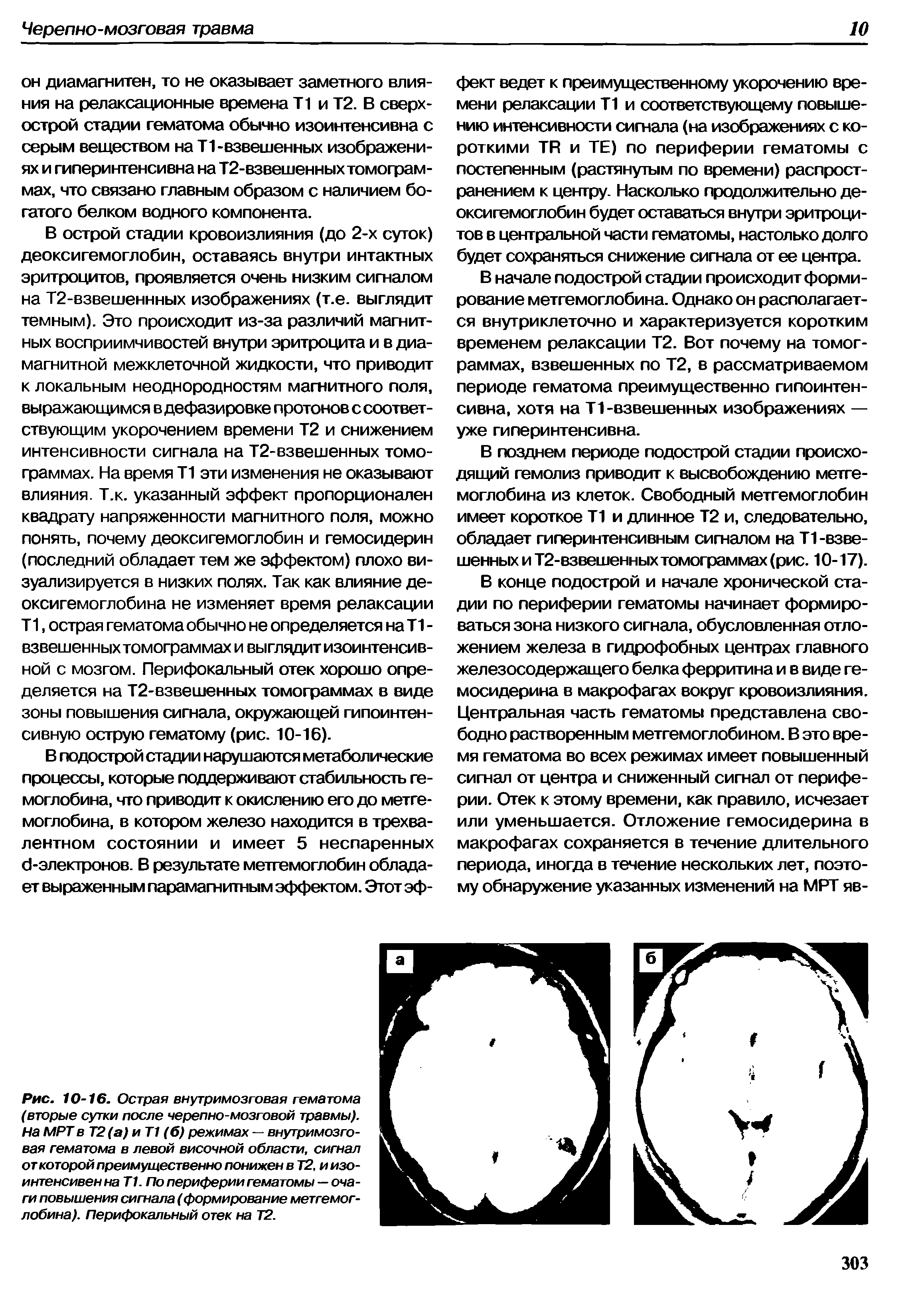 Рис. 10-16. Острая внутримозговая гематома (вторые сутки после черепно-мозговой травмы). На МРТ вТ2(а)иТ1 (б) режимах — внутримозговая гематома в левой височной области, сигнал от которой преимущественно понижен вТ2,и изо-интенсивен на Т1. По периферии гематомы — очаги повышения сигнала (формирование метгемоглобина). Перифокальный отек на Т2.