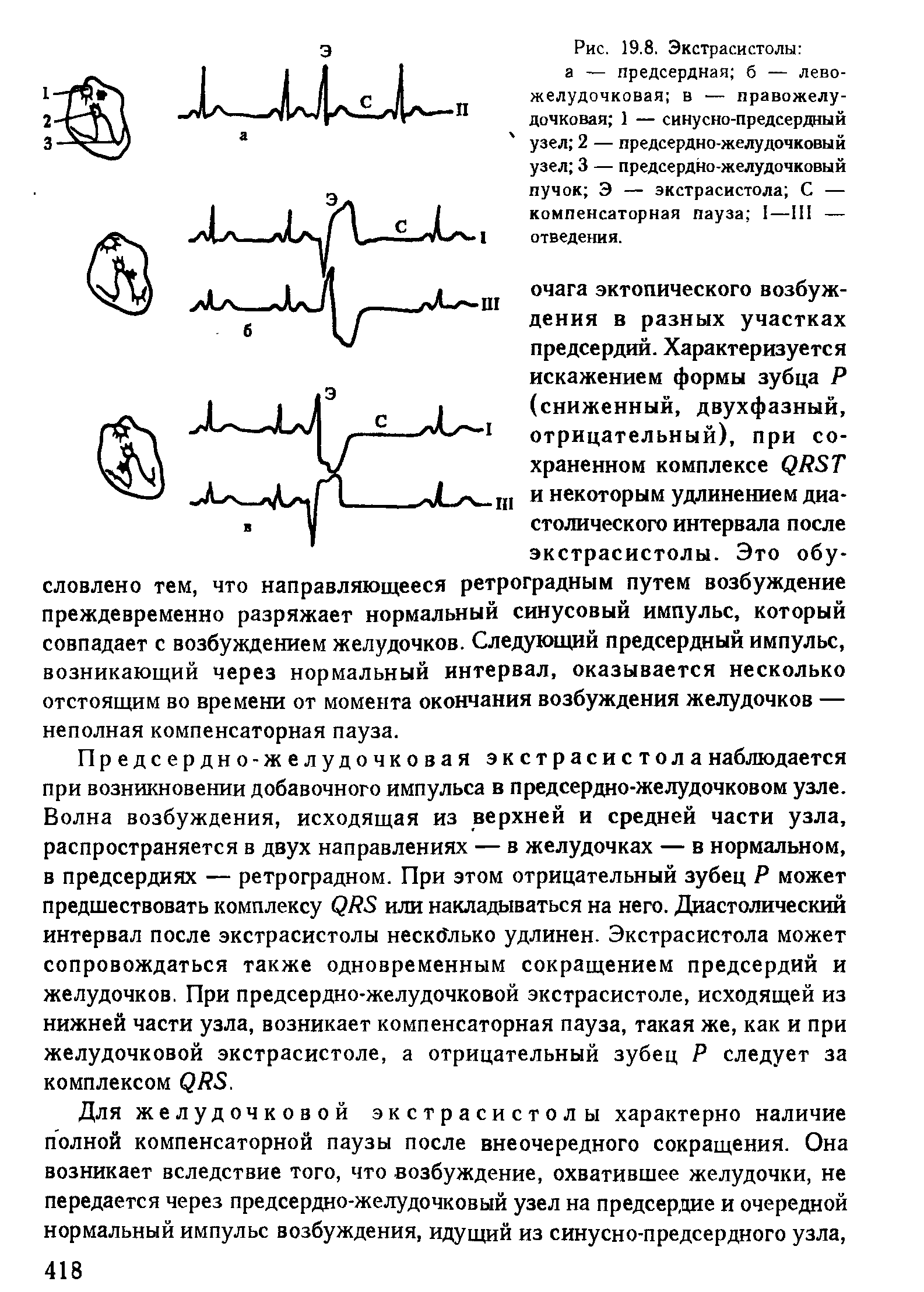 Рис. 19.8. Экстрасистолы а — предсердная б — левожелудочковая в — правожелудочковая 1 — синусно-предсердный узел 2 — предсердно-желудочковый узел 3 — предсердно-желудочковый пучок Э — экстрасистола С — компенсаторная пауза 1—111 — отведения.