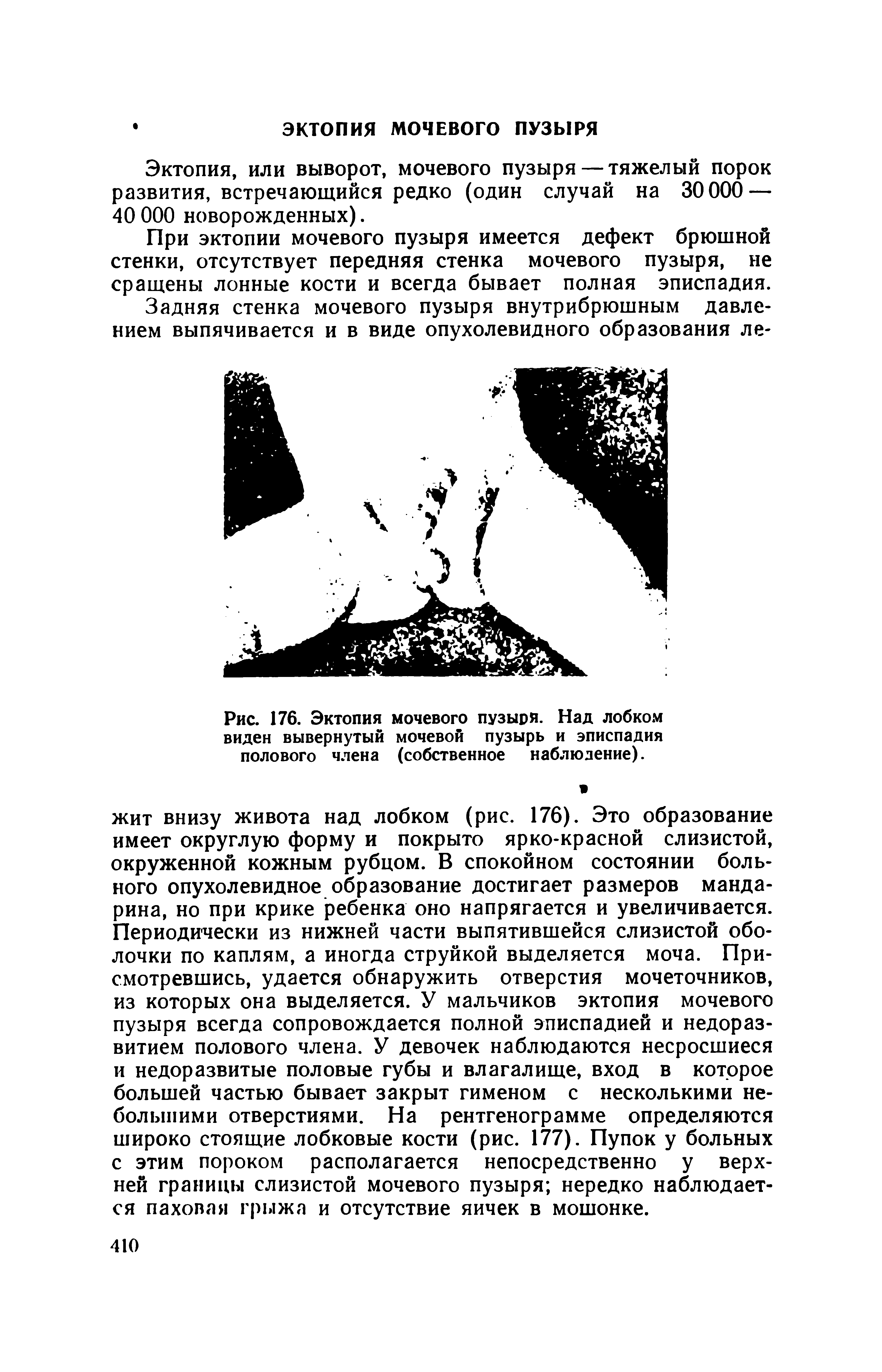 Рис. 176. Эктопия мочевого пузыря. Над лобком виден вывернутый мочевой пузырь и эписпадия полового члена (собственное наблюдение).