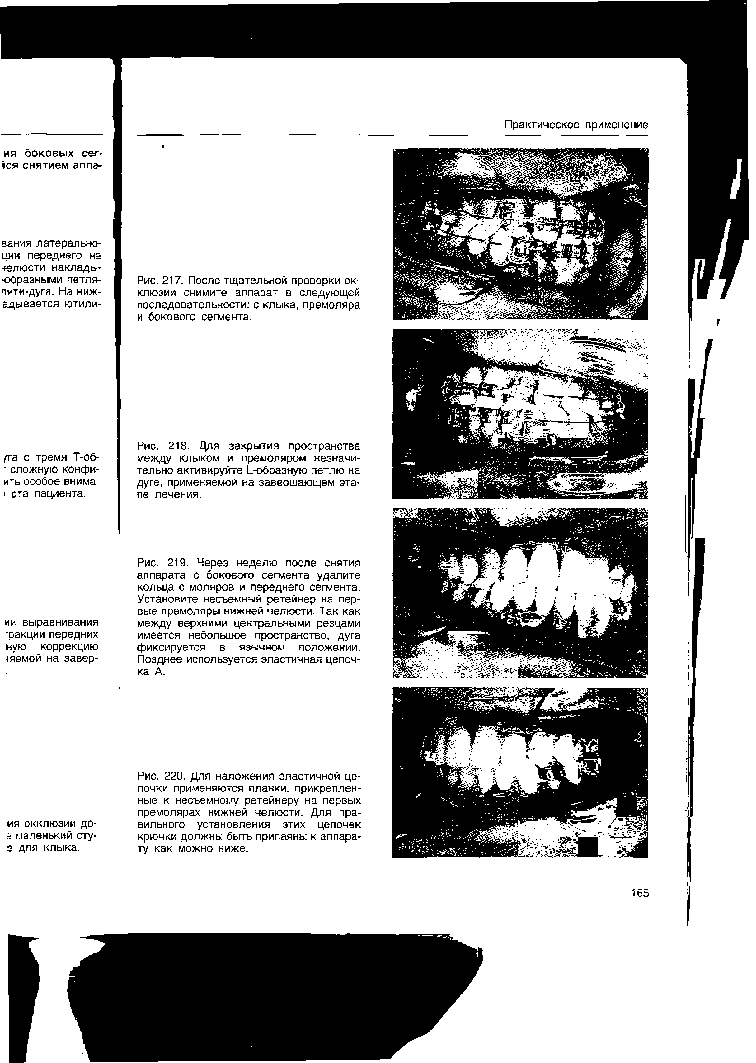 Рис. 220. Для наложения эластичной цепочки применяются планки, прикрепленные к несъемному ретейнеру на первых премолярах нижней челюсти. Для правильного установления этих цепочек крючки должны быть припаяны к аппарату как можно ниже.