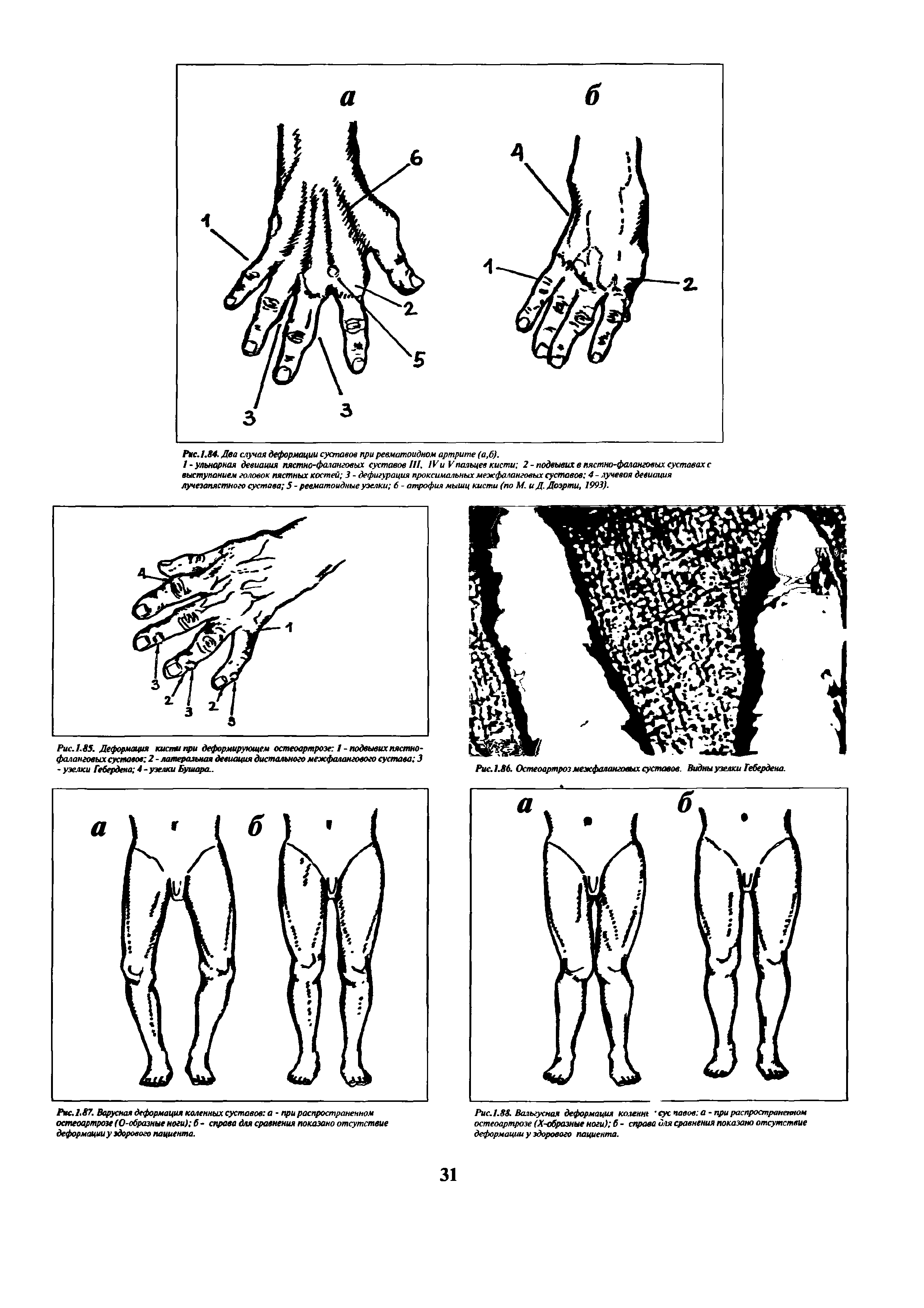 Рис.1.88 Вальгусная деформация колент сус павов а - при распространенном остеоартрозе (Х-образные ноги) б - справа иля сравнения показано отсутствие деформации у здорового пациента.