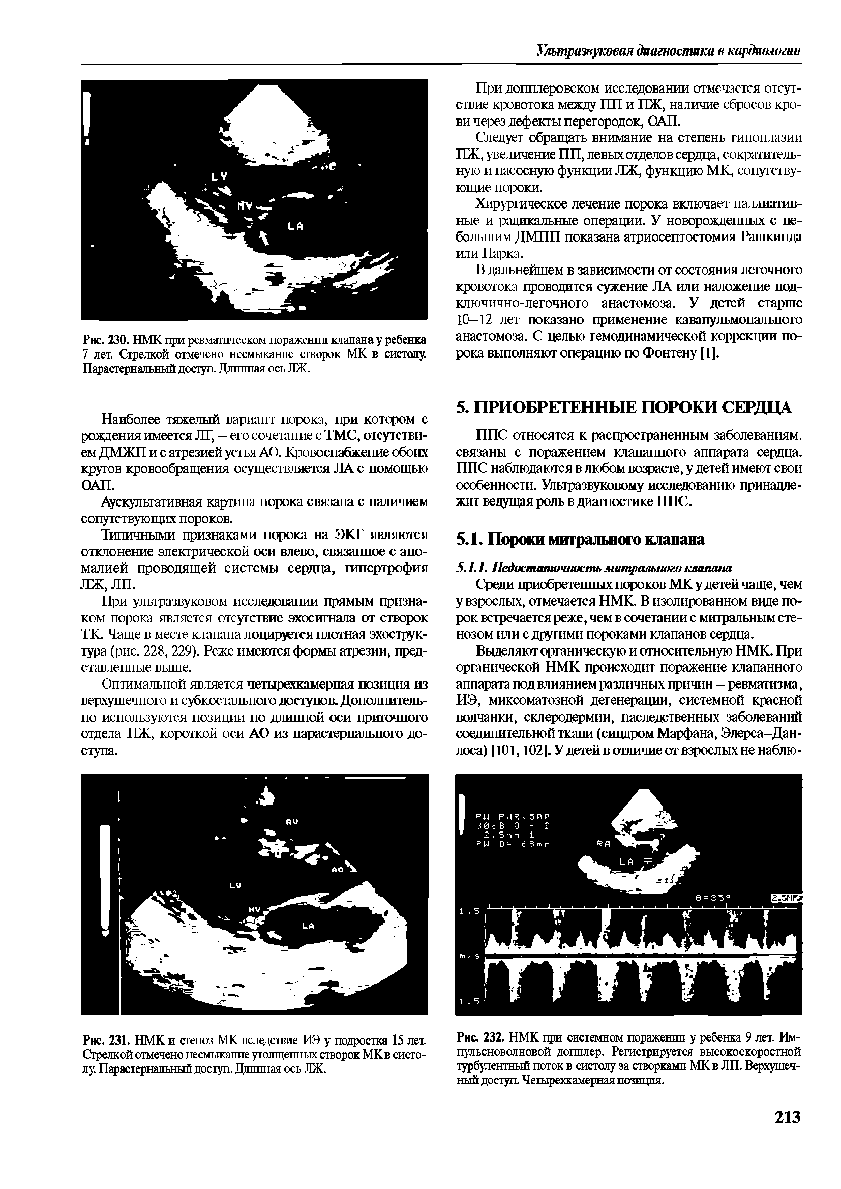 Рис. 232. НМК при системном поражении у ребенка 9 лет. Импульсноволновой допплер. Регистрируется высокоскоростной турбулентный поток в систолу за створками МК в ЛП. Верхушечный доступ. Четырехкамерная позиция.