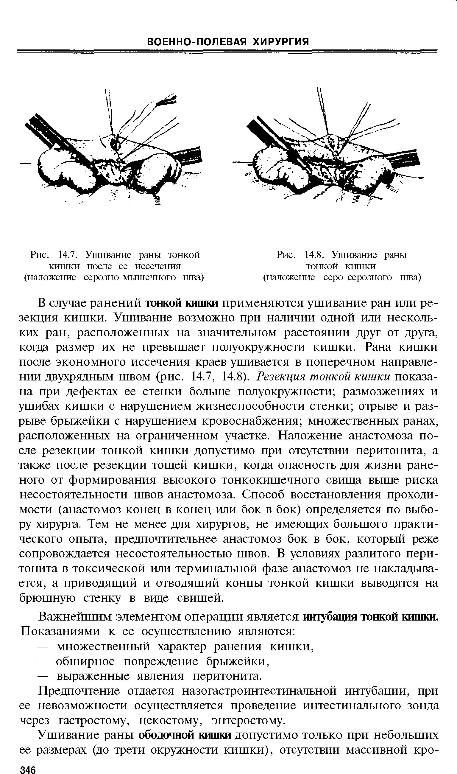 Рис. 14.7. Ушивание раны тонкой кишки после ее иссечения (наложение серозно-мышечного шва)...