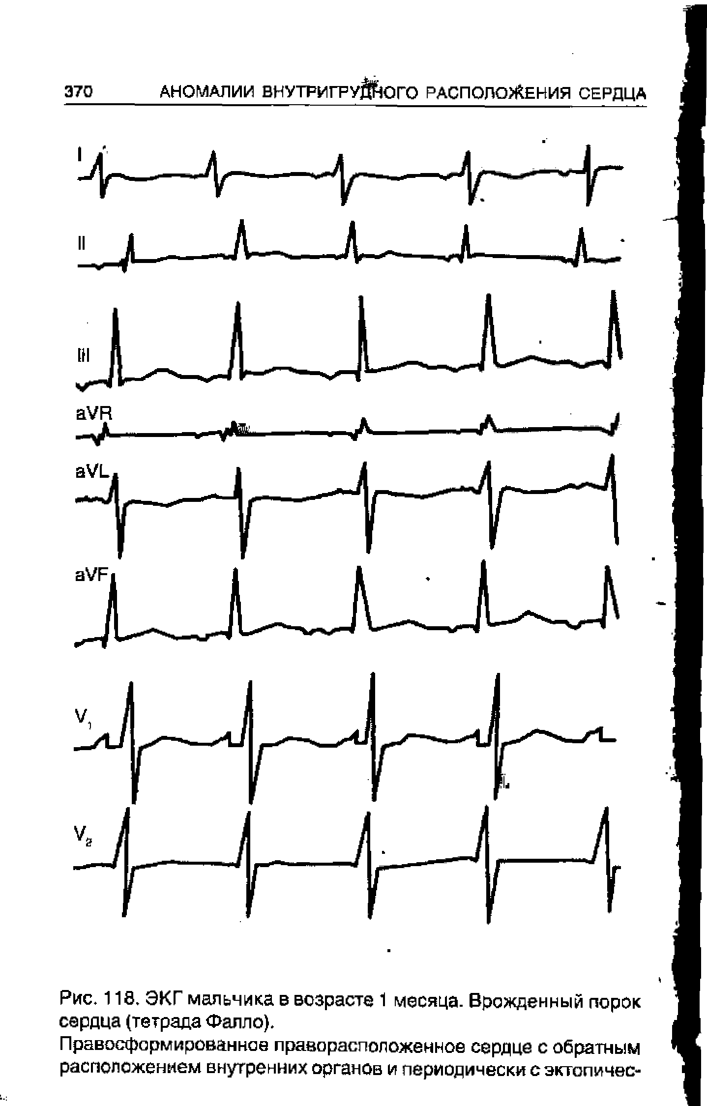 Рис. 118. ЭКГ мальчика в возрасте 1 месяца. Врожденный порок сердца (тетрада Фалло).
