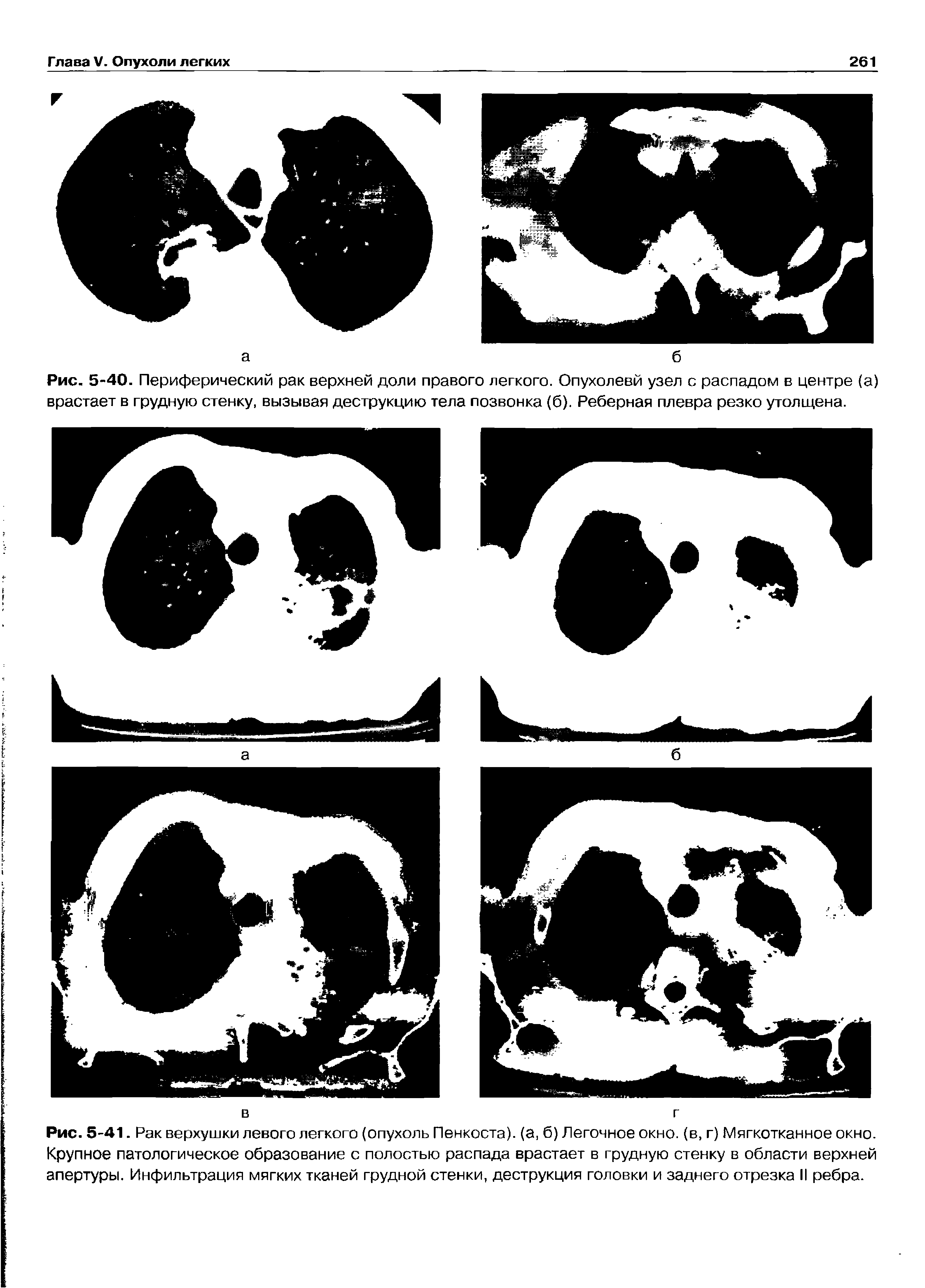 Рис. 5-41. Рак верхушки левого легкого (опухоль Пенкоста). (а, б) Легочное окно, (в, г) Мягкотканное окно. Крупное патологическое образование с полостью распада врастает в грудную стенку в области верхней апертуры. Инфильтрация мягких тканей грудной стенки, деструкция головки и заднего отрезка II ребра.