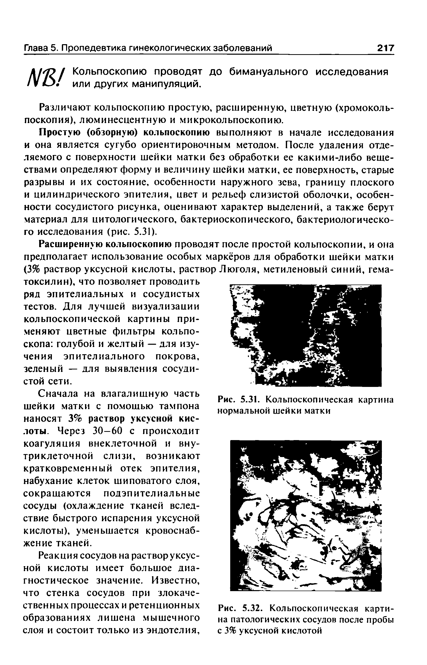 Рис. 5.32. Кольпоскопическая картина патологических сосудов после пробы с 3% уксусной кислотой...