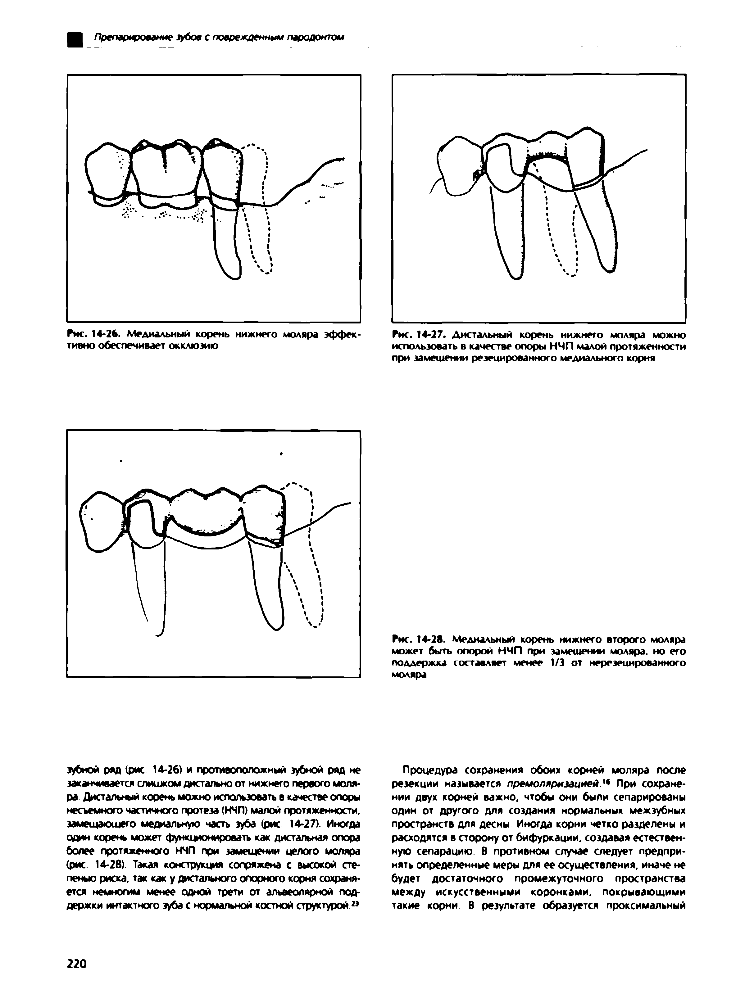 Рис. 14-27. Дистальный корень нижнего моляра можно использовать в качестве опоры НЧП малой протяженности при замещении резецированного медиального корня...